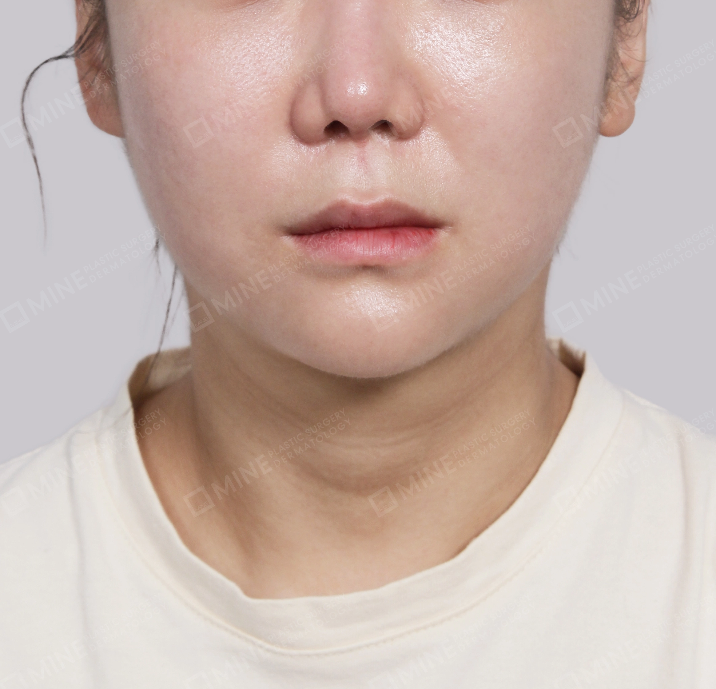 Hút mỡ nọng buộc cơ-Mặt trước-Sau