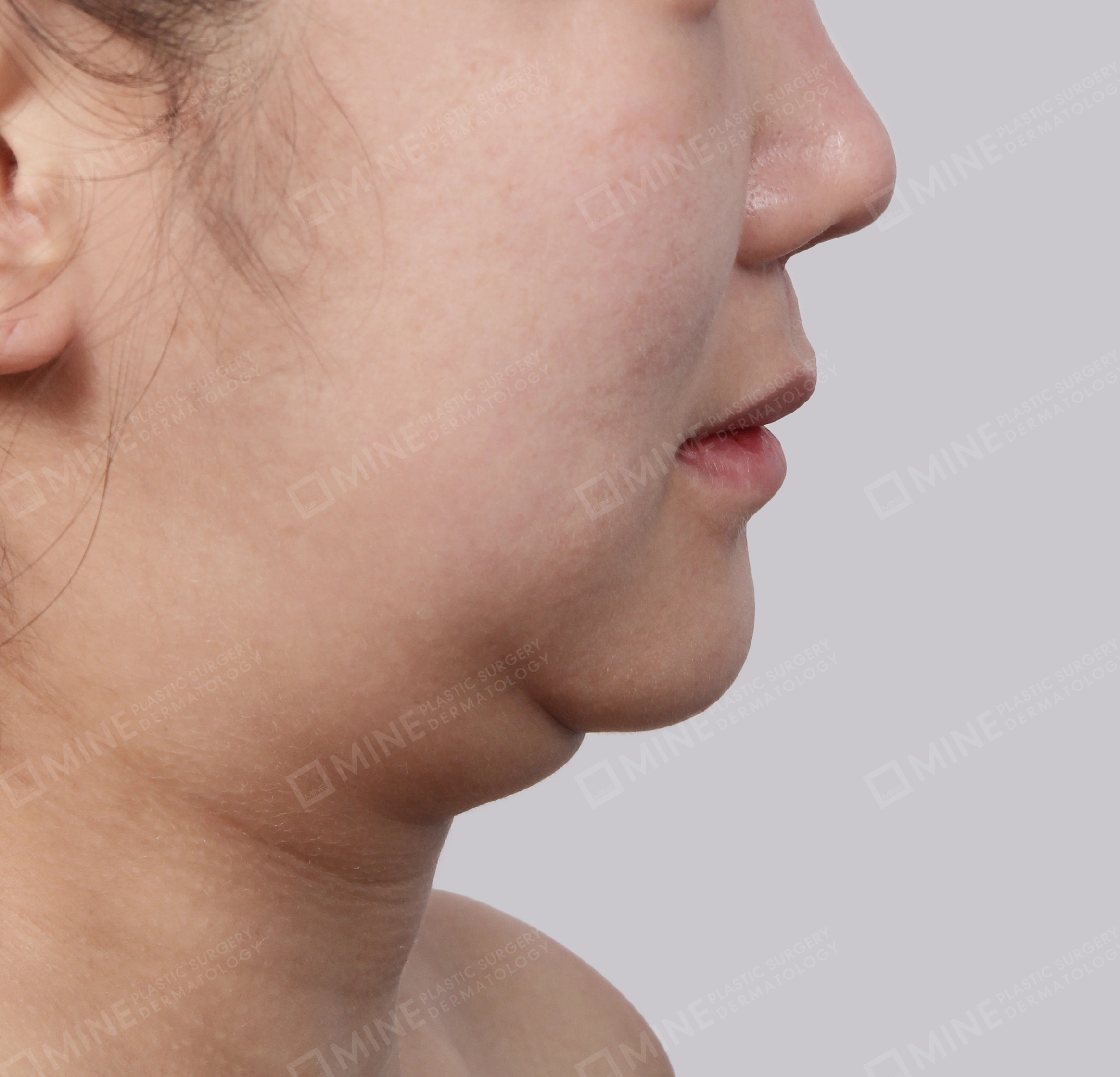 Hút mỡ nọng buộc cơ-Mặt bên-Trước