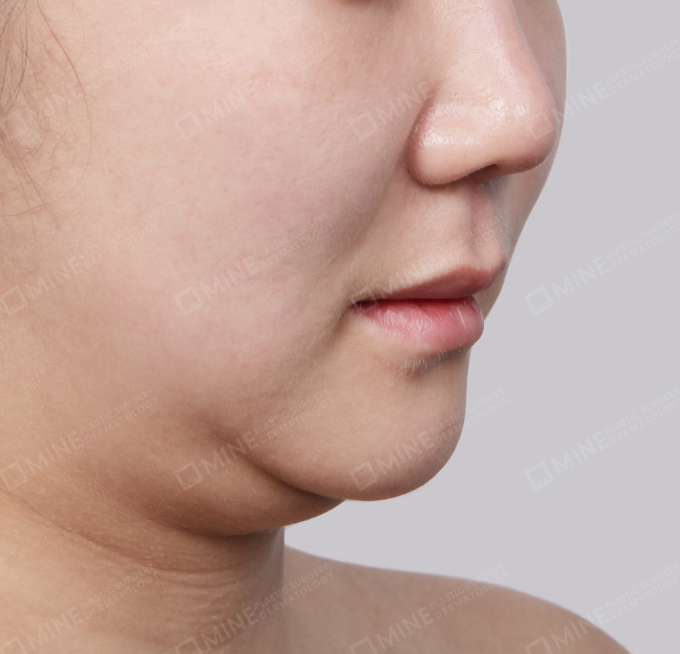 Hút mỡ nọng buộc cơ-45 độ-Trước