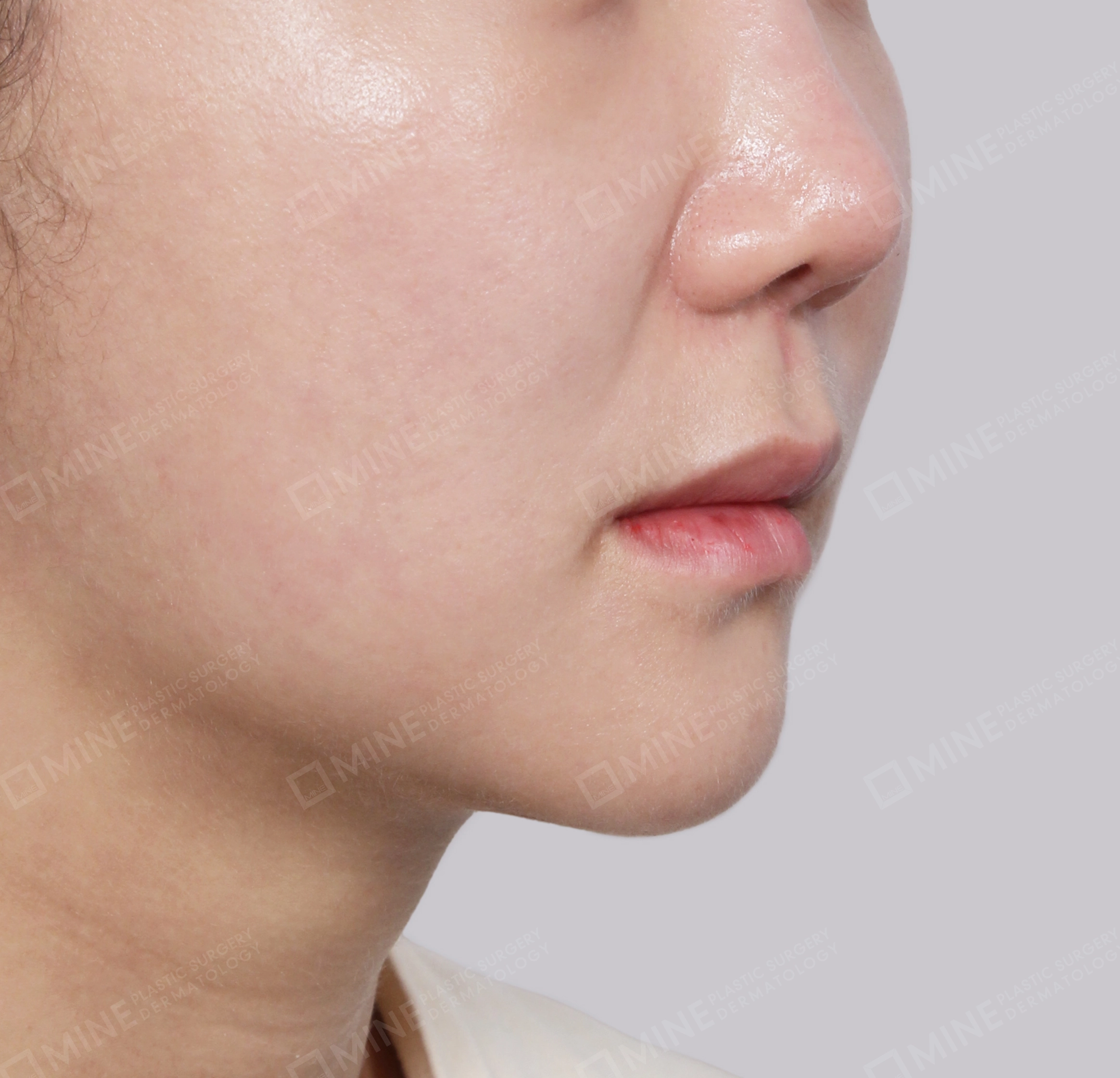 Hút mỡ nọng buộc cơ-45 độ-Sau