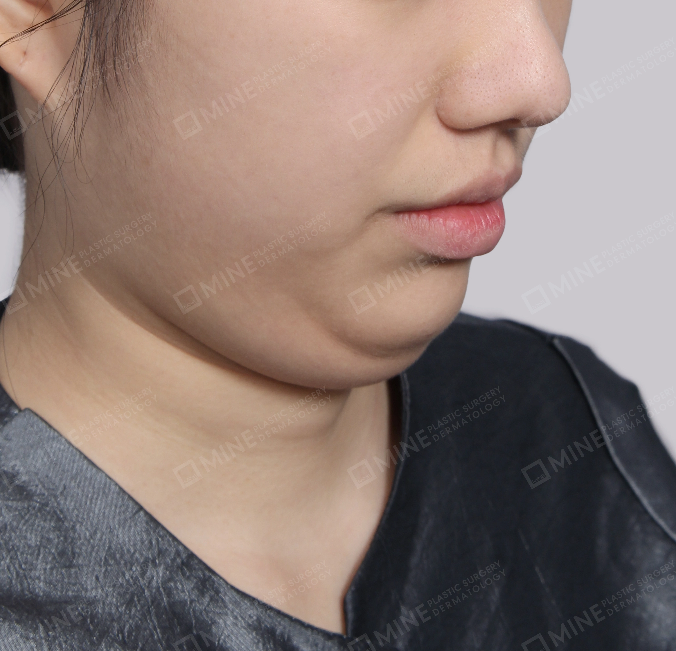 Hút mỡ nọng buộc cơ-Mặt trước-Trước