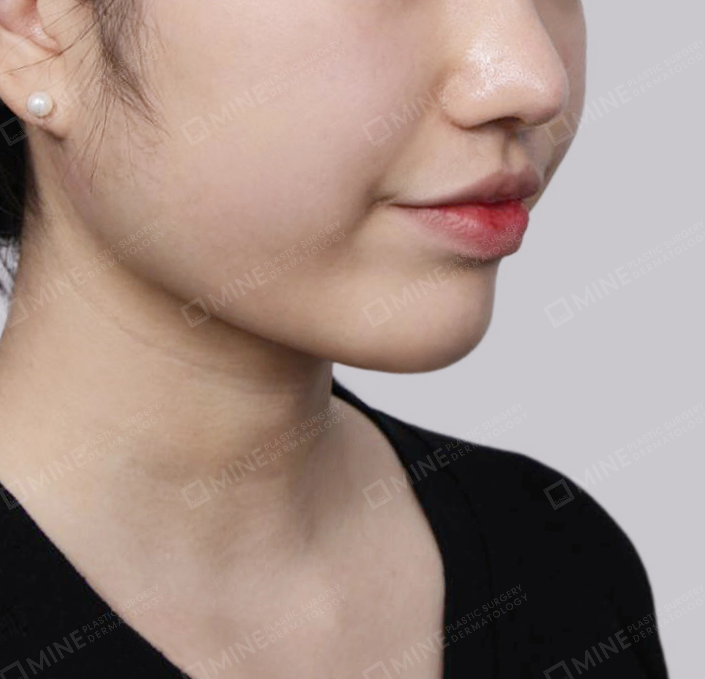 Hút mỡ nọng buộc cơ-Mặt trước-Sau