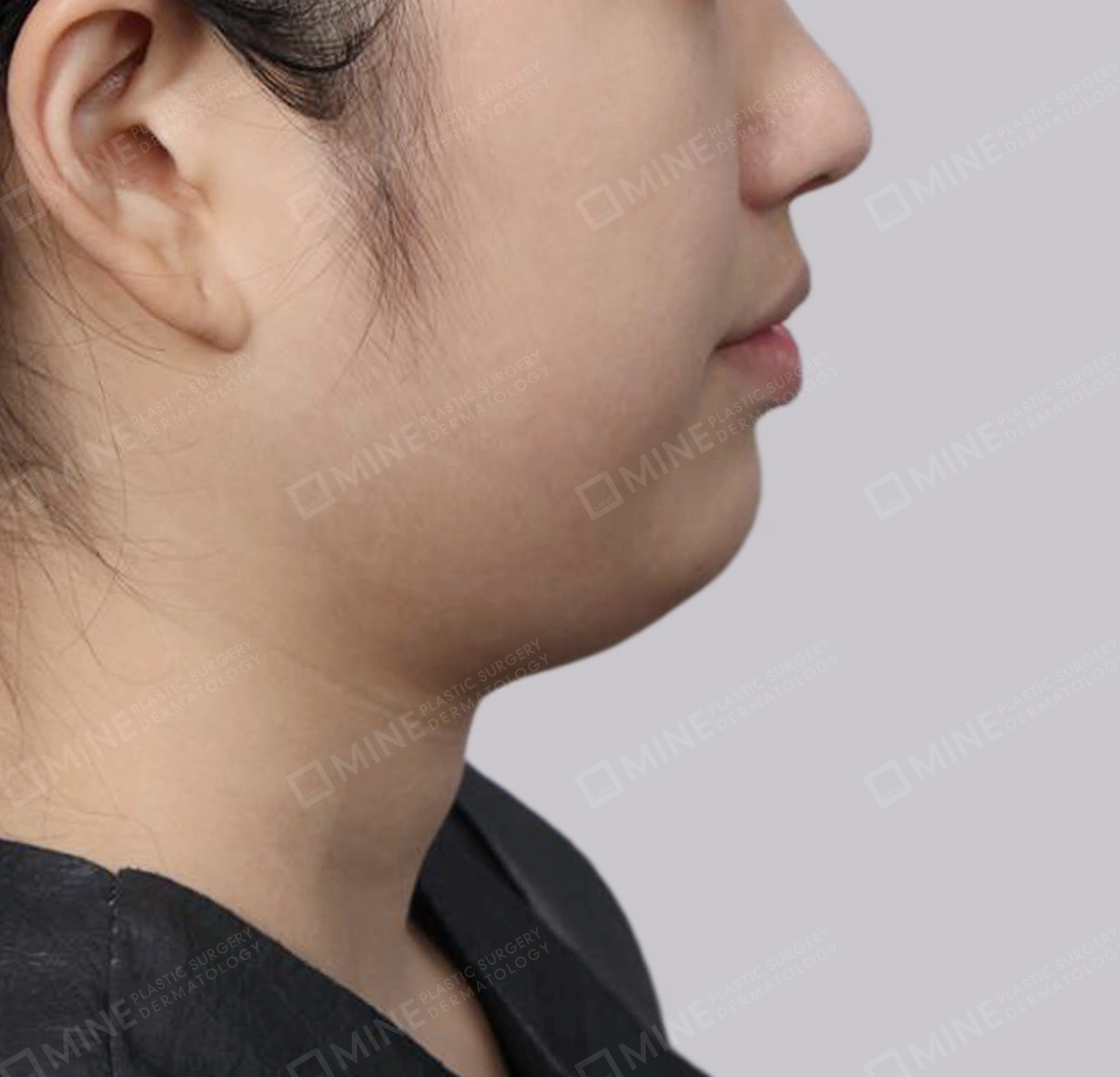 Hút mỡ nọng buộc cơ-Mặt bên-Trước
