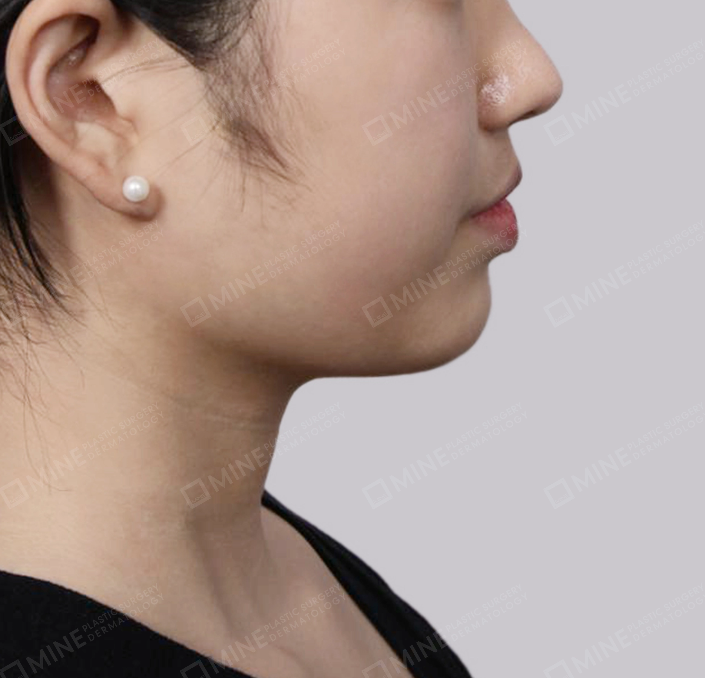 Hút mỡ nọng buộc cơ-Mặt bên-Sau