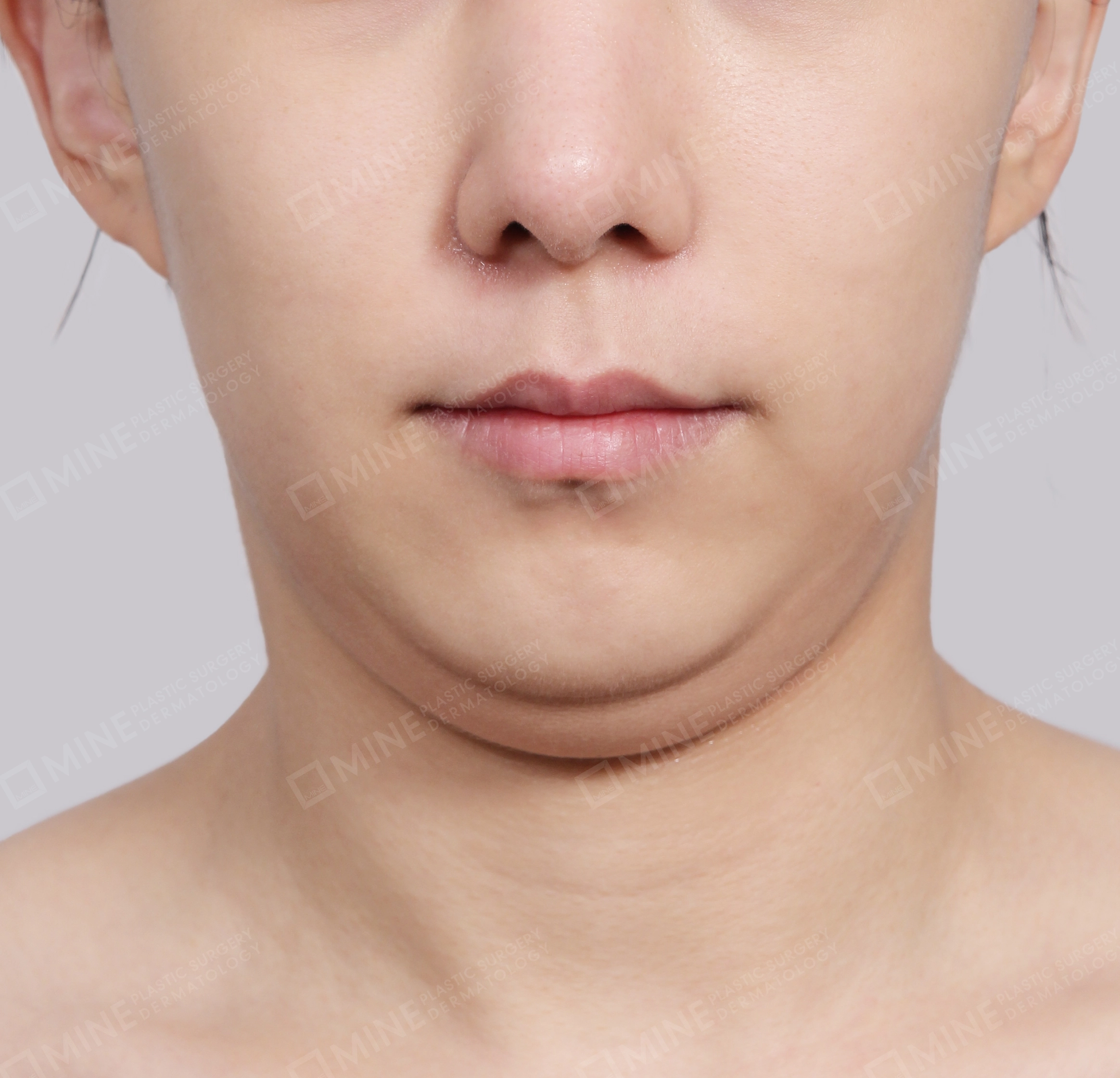 Hút mỡ nọng buộc cơ-Mặt trước-Trước