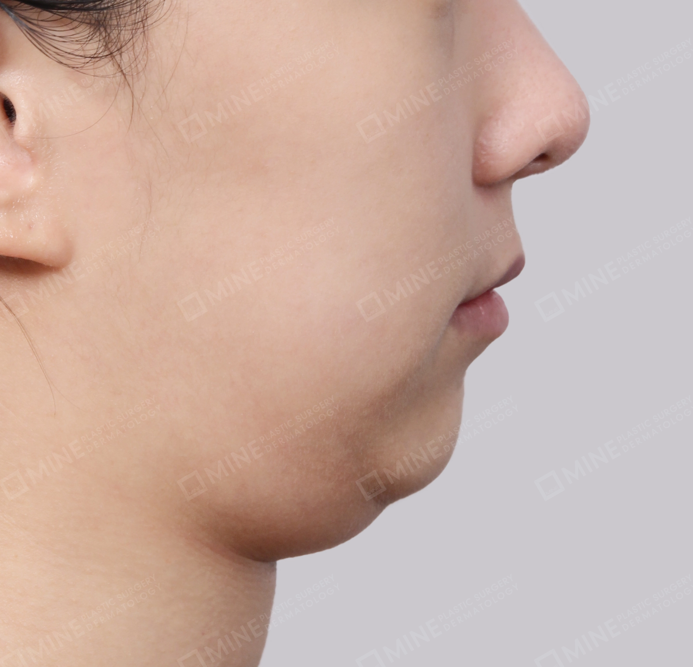 Hút mỡ nọng buộc cơ-Mặt bên-Trước