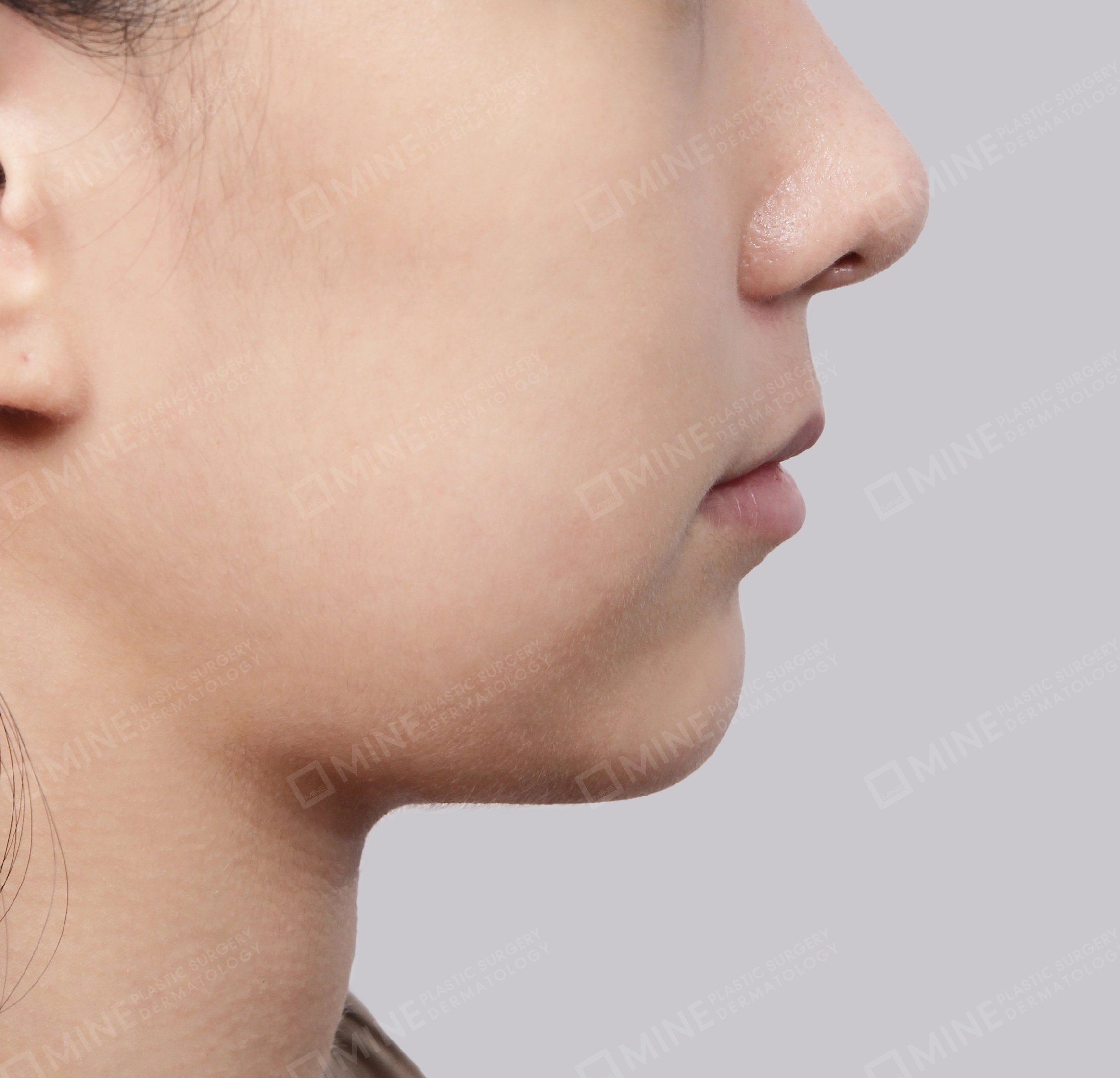 Hút mỡ nọng buộc cơ-Mặt bên-Sau