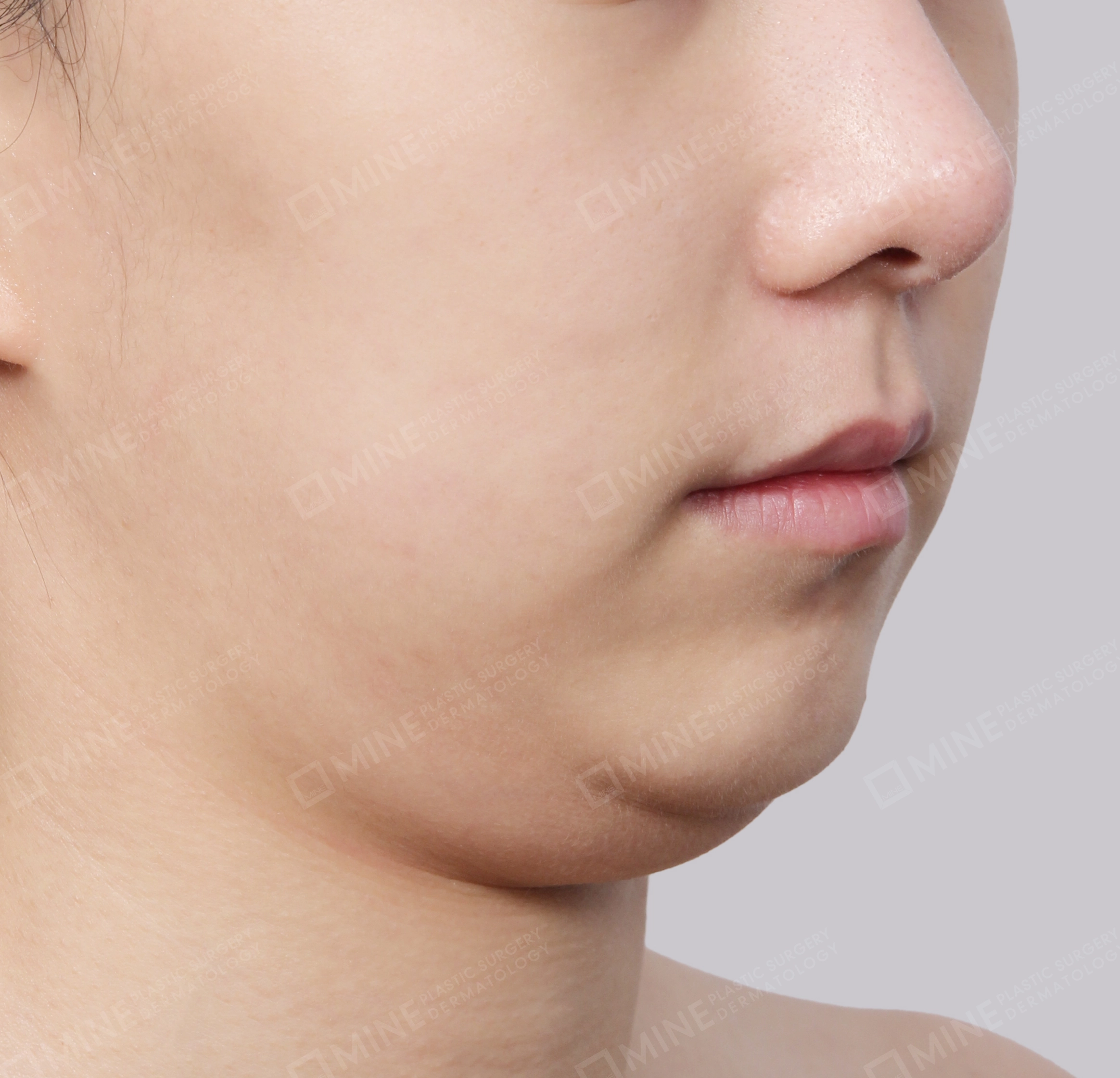 Hút mỡ nọng buộc cơ-45 độ-Trước