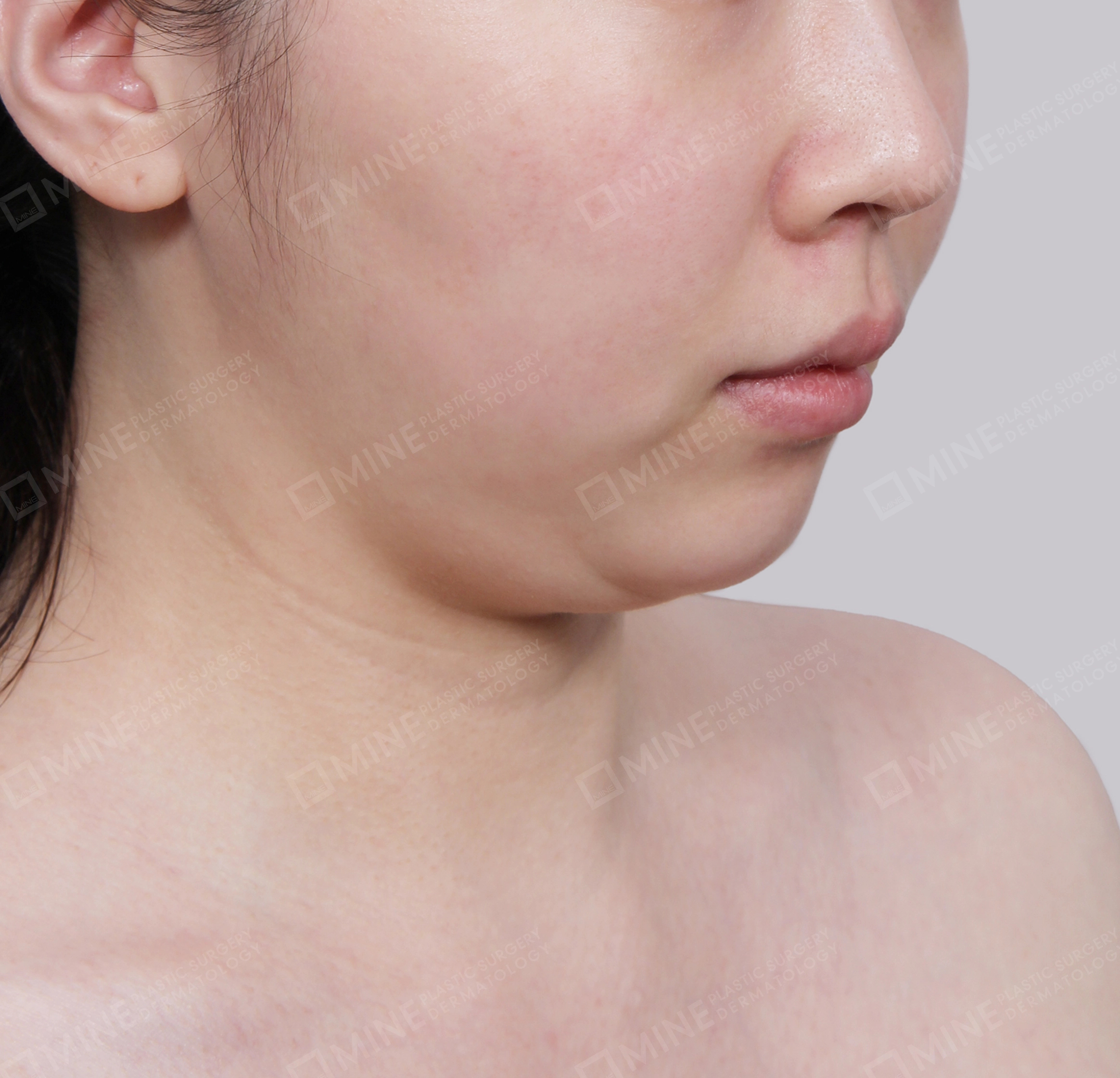 Hút mỡ nọng buộc cơ-Mặt trước-Trước
