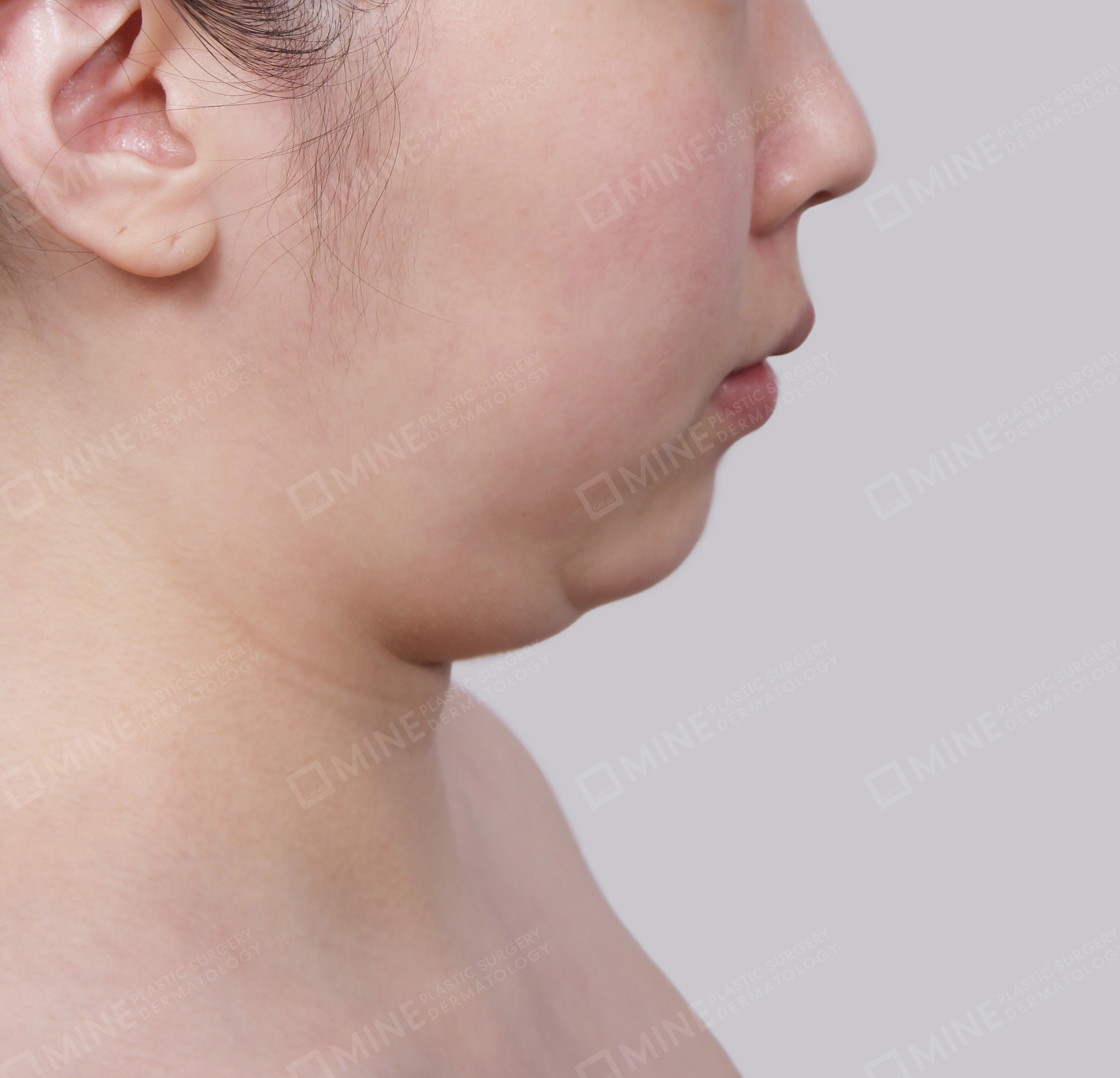 Hút mỡ nọng buộc cơ-Mặt bên-Trước