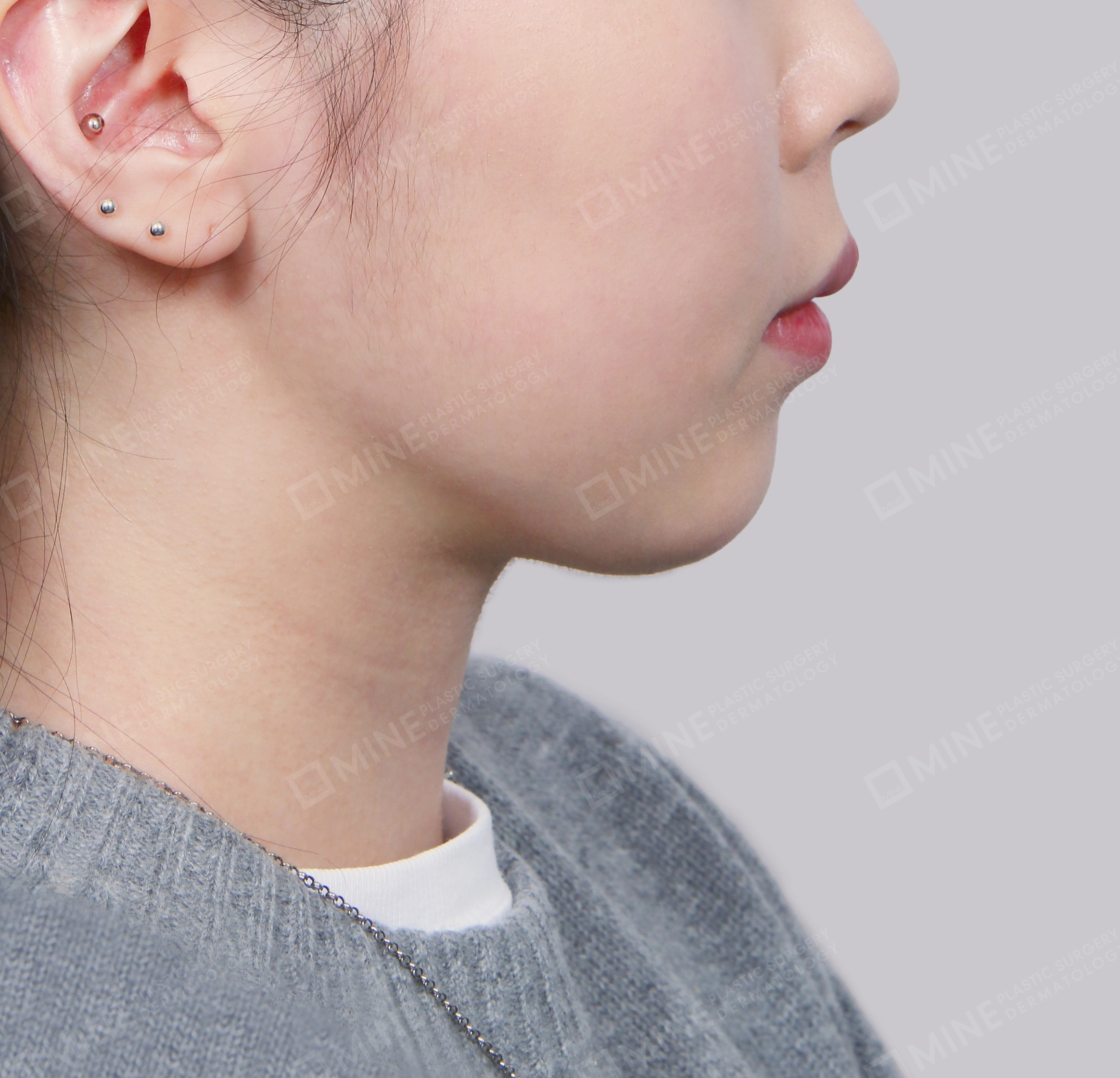 Hút mỡ nọng buộc cơ-Mặt bên-Sau
