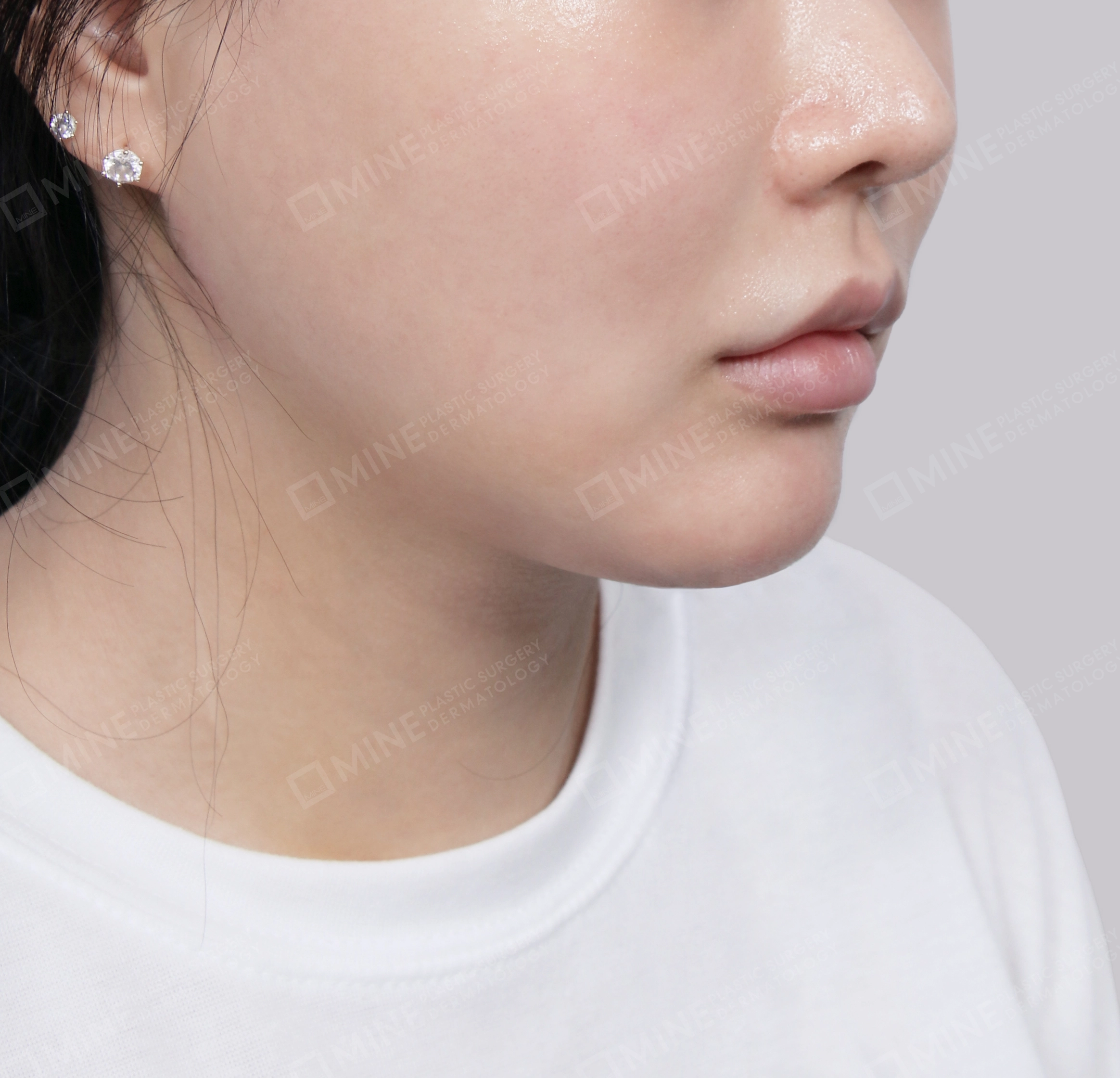 Hút mỡ nọng buộc cơ-Mặt trước-Sau