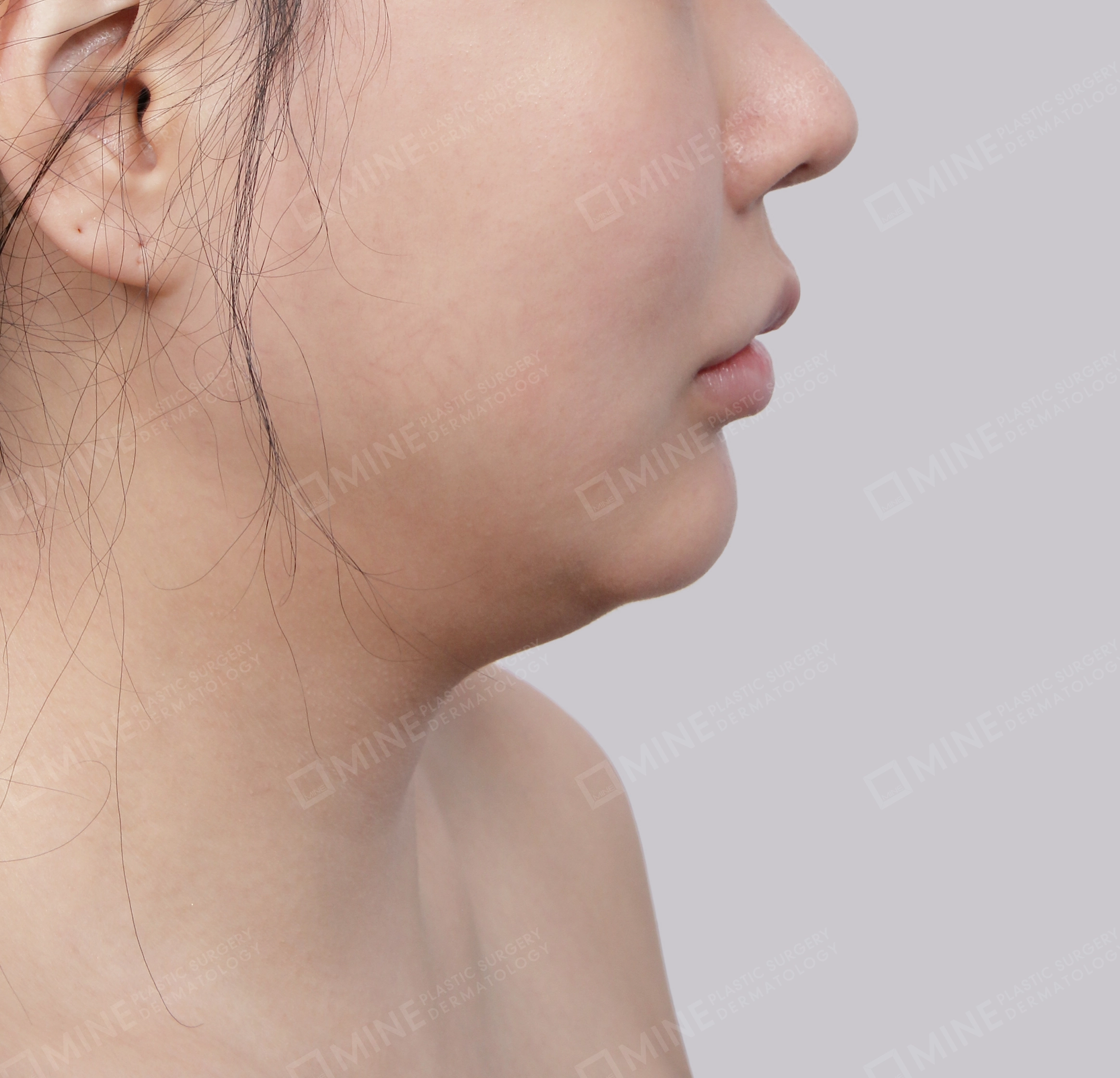 Hút mỡ nọng buộc cơ-Mặt bên-Trước