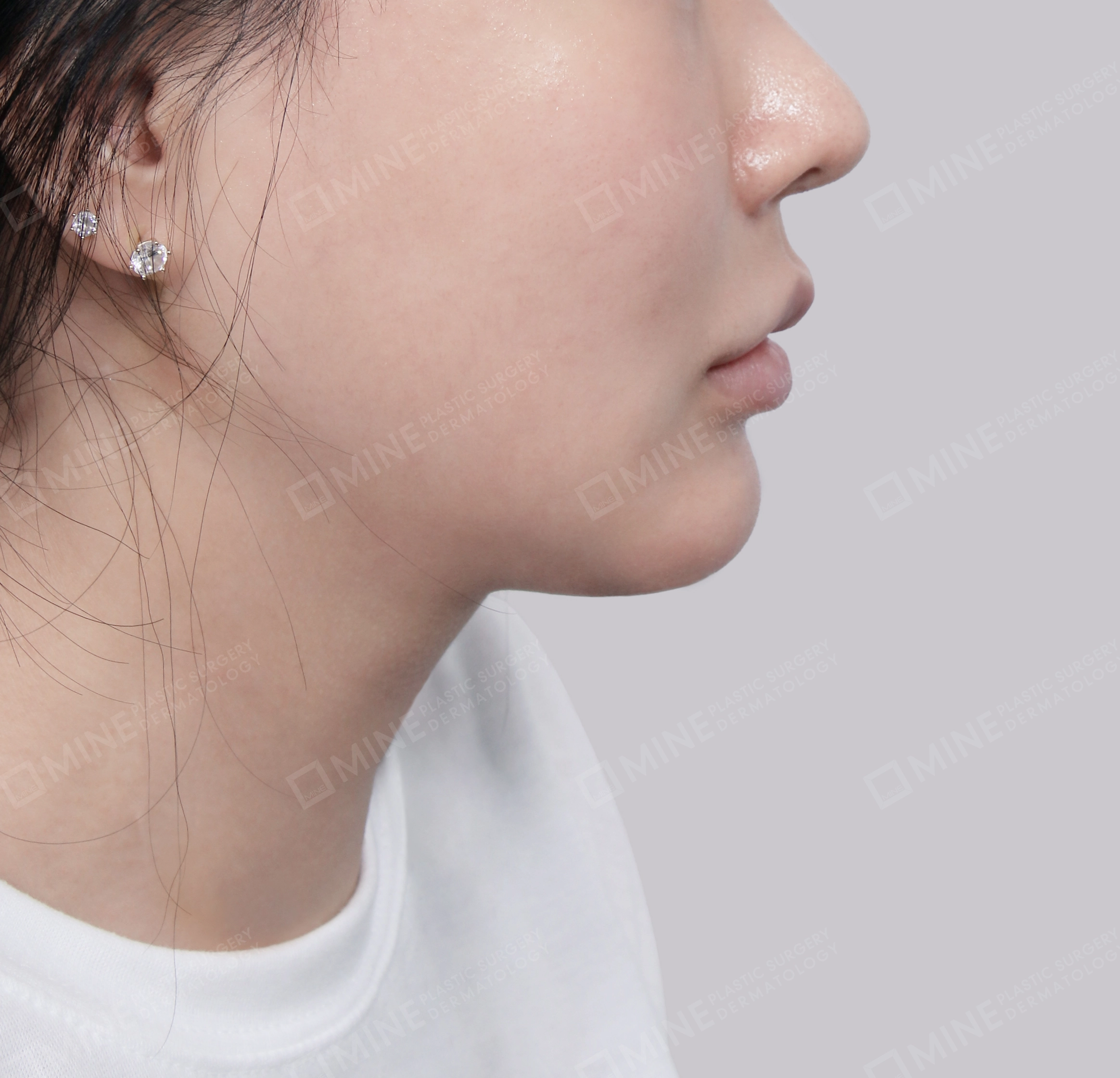 Hút mỡ nọng buộc cơ-Mặt bên-Sau