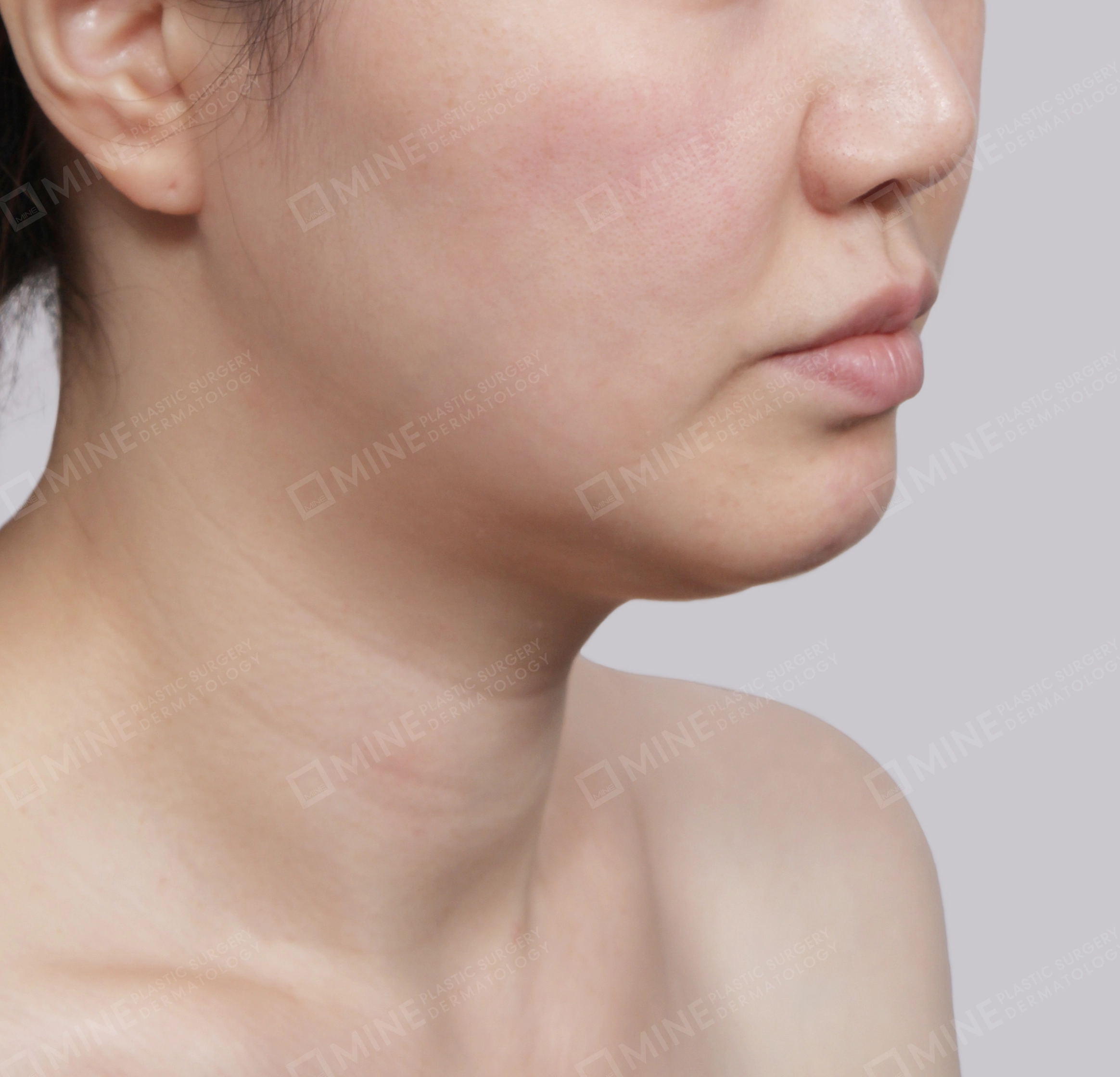Hút mỡ nọng buộc cơ-Mặt trước-Trước