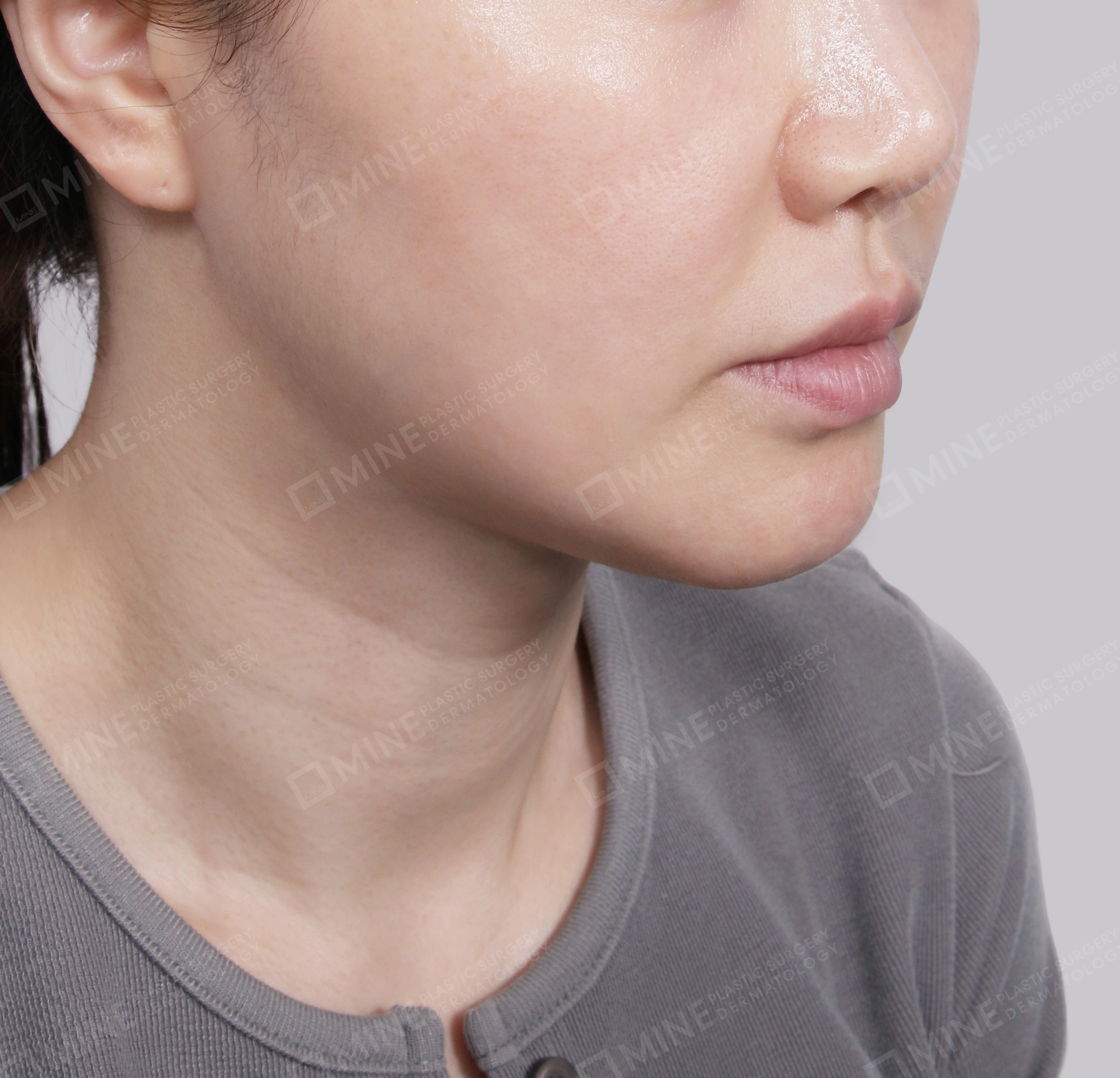 Hút mỡ nọng buộc cơ-Mặt trước-Sau