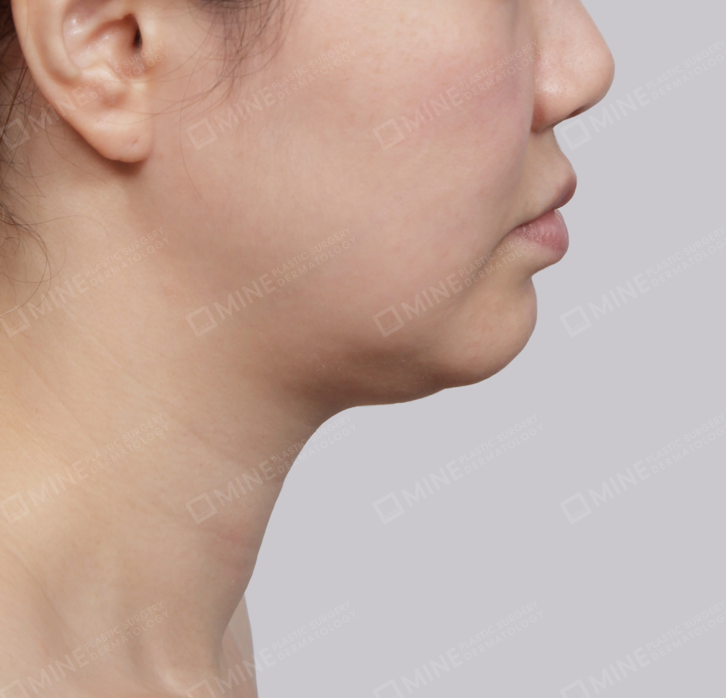 Hút mỡ nọng buộc cơ-Mặt bên-Trước