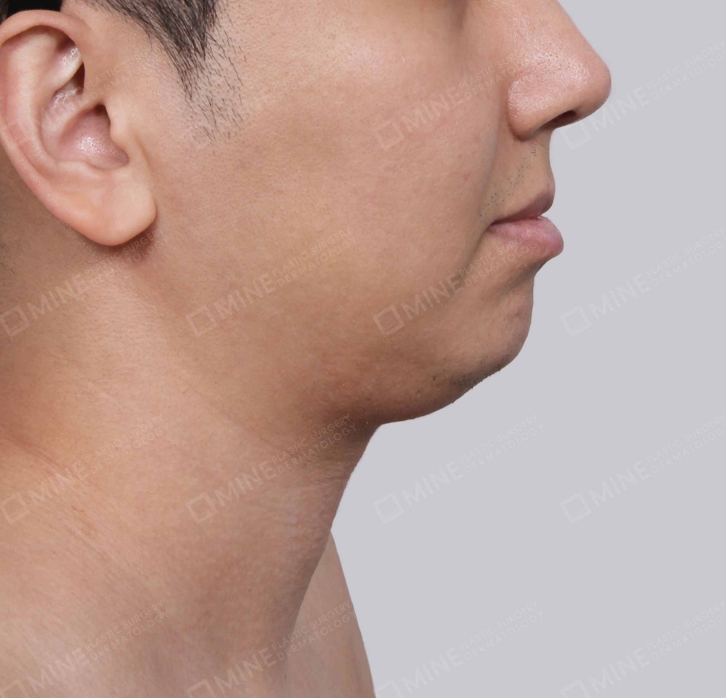 Hút mỡ nọng buộc cơ-Mặt bên-Trước