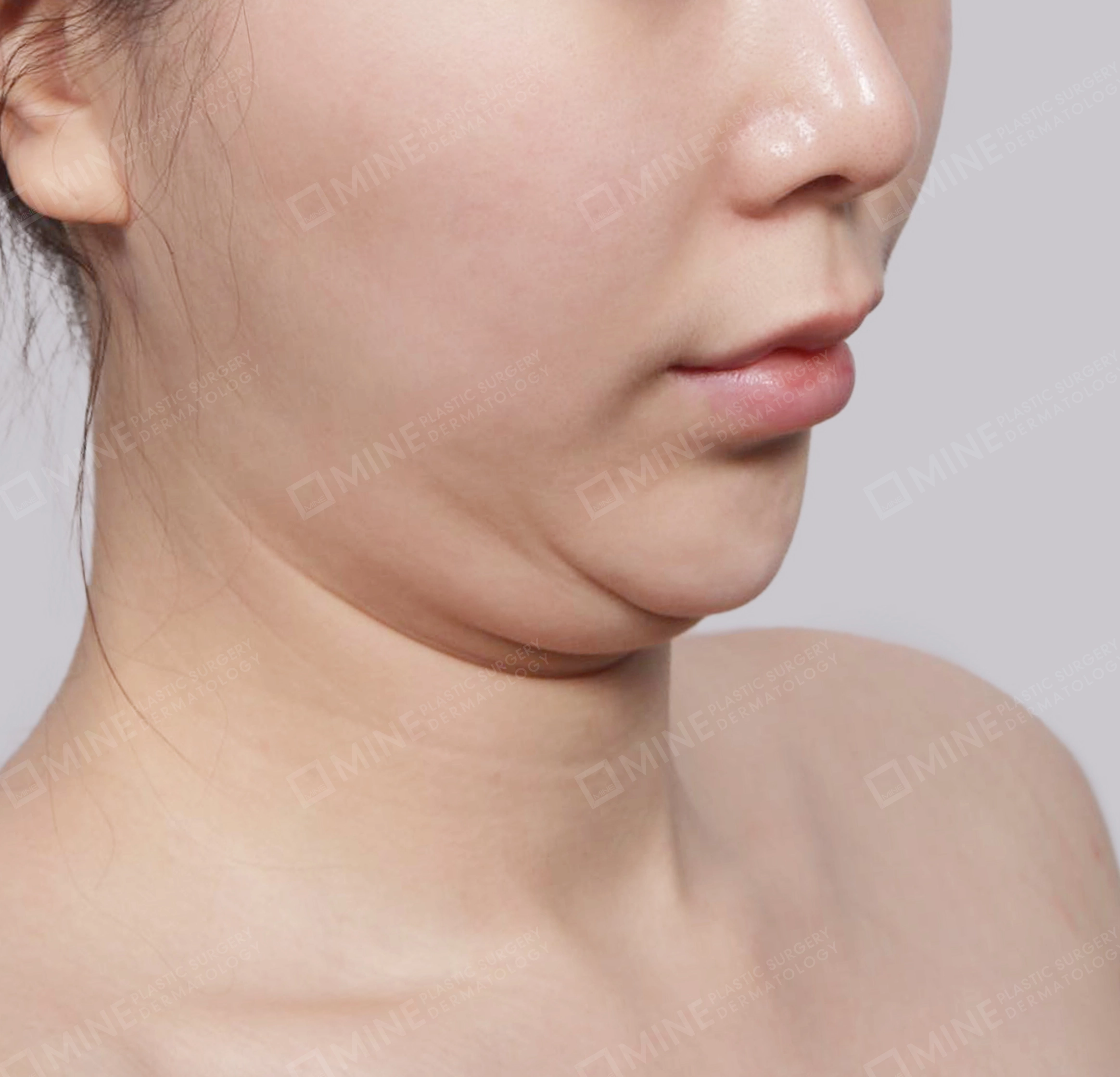 Hút mỡ nọng buộc cơ-Mặt trước-Trước