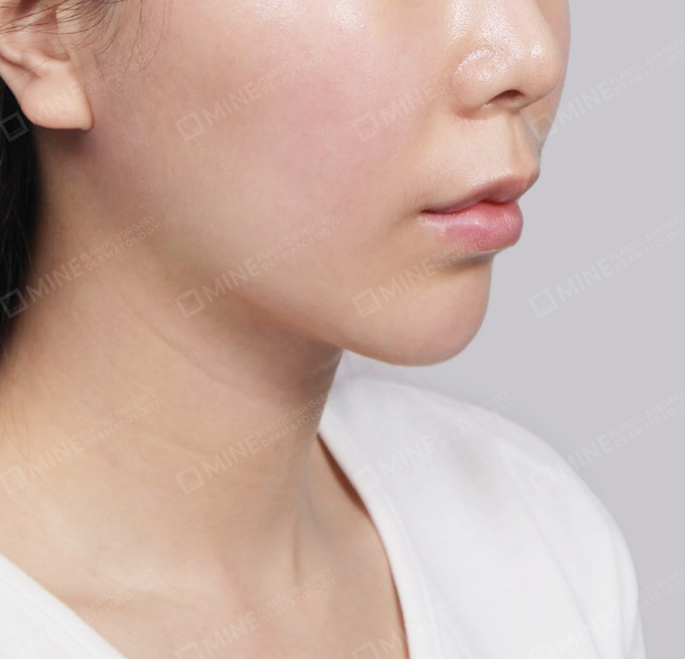 Hút mỡ nọng buộc cơ-Mặt trước-Sau