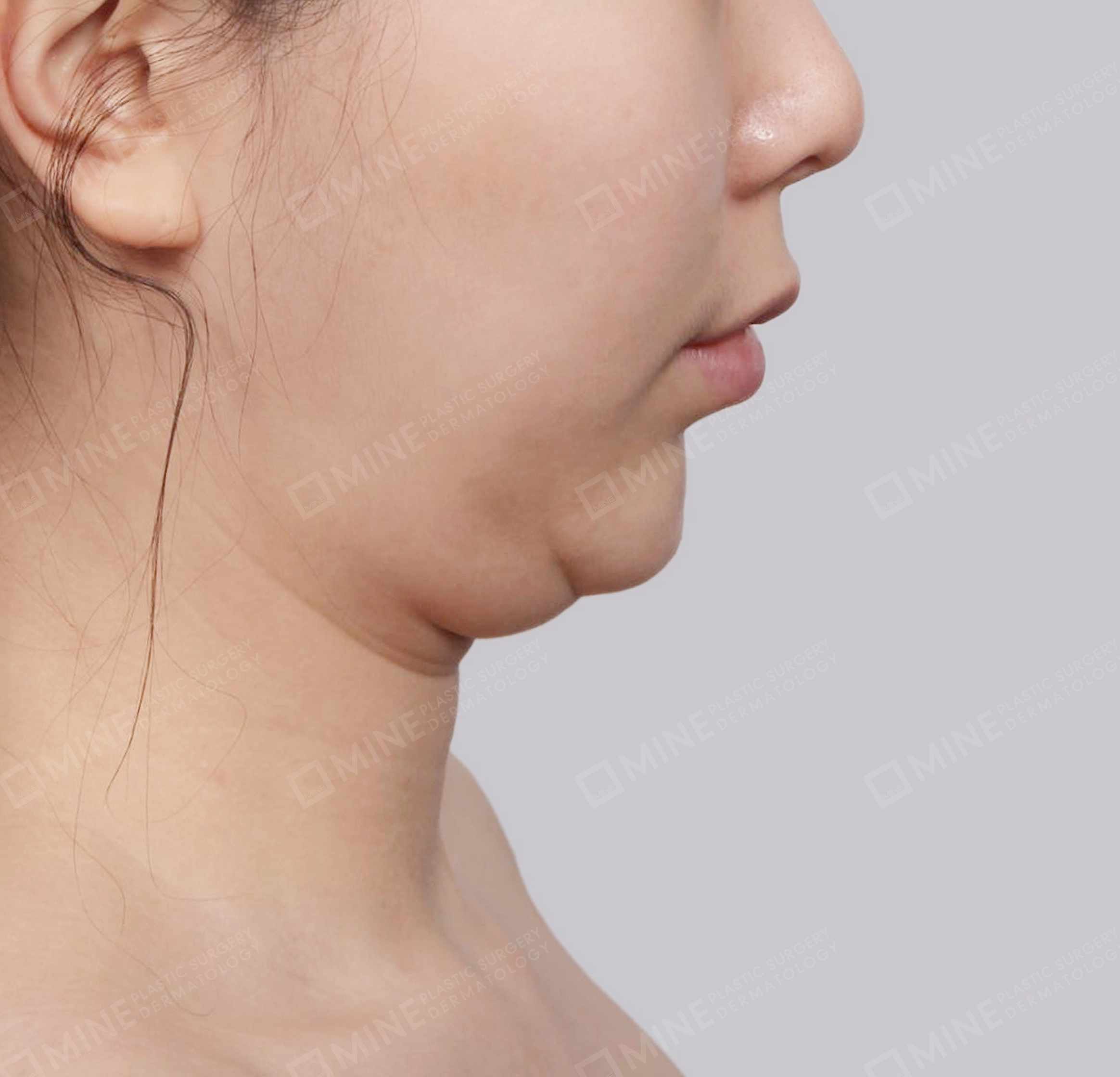 Hút mỡ nọng buộc cơ-Mặt bên-Trước