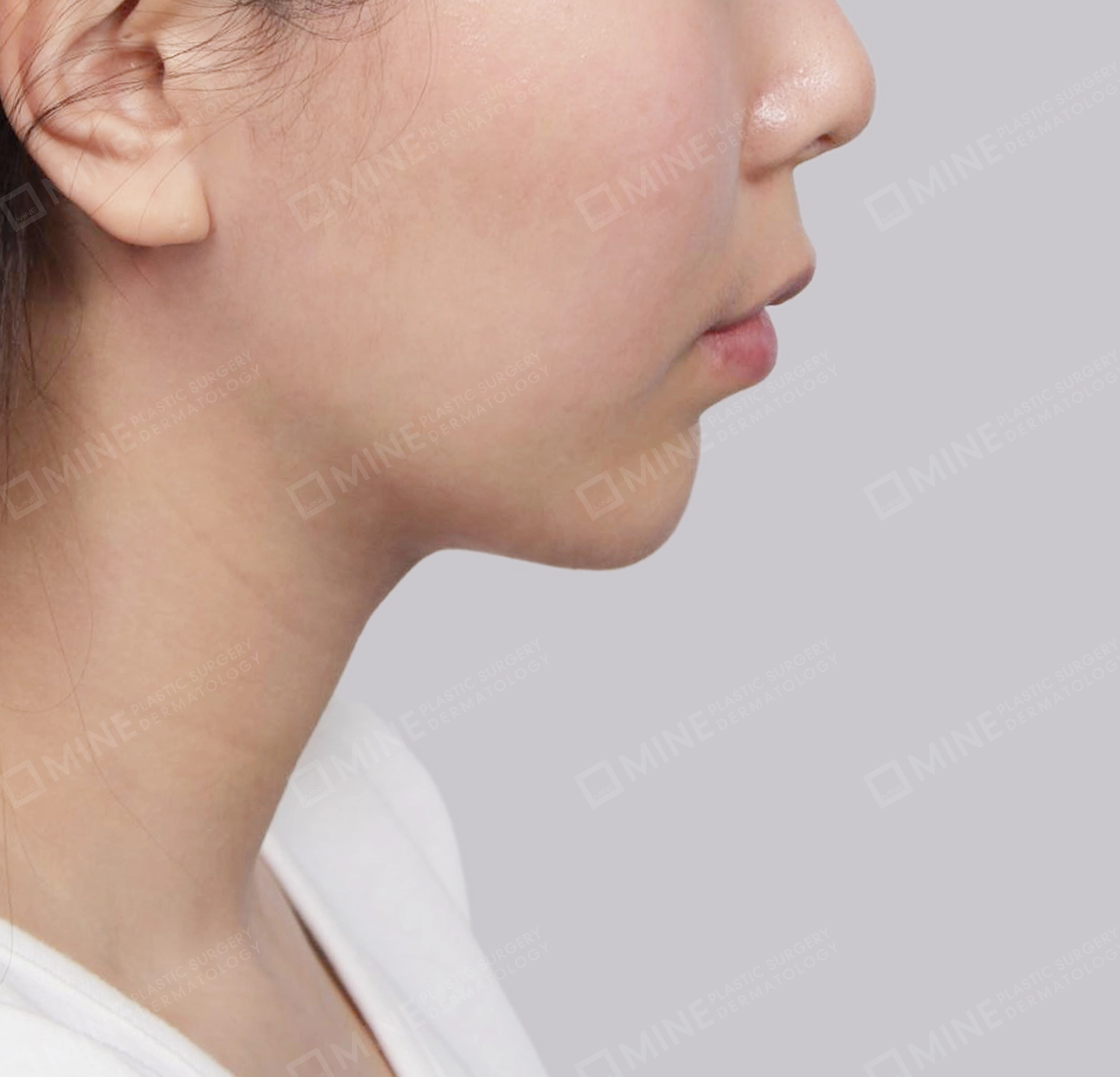 Hút mỡ nọng buộc cơ-Mặt bên-Sau