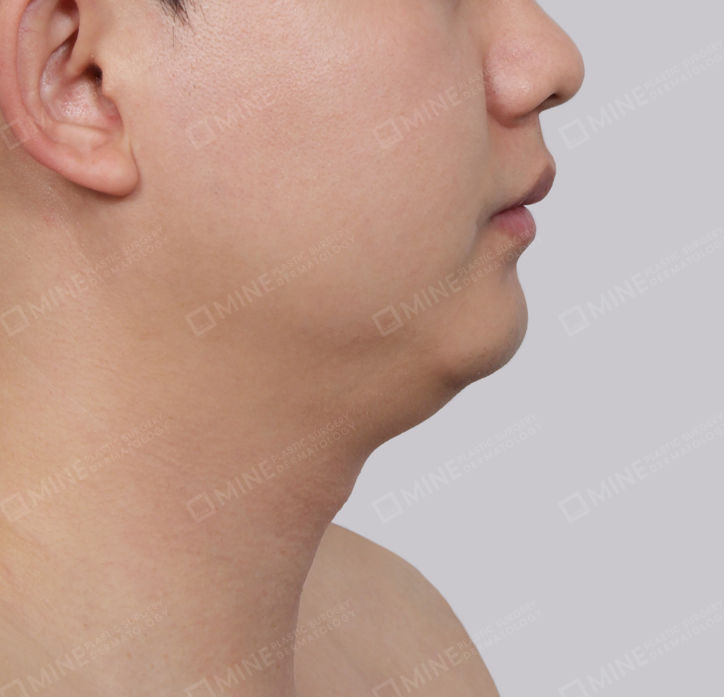 Hút mỡ nọng buộc cơ-Mặt bên-Trước