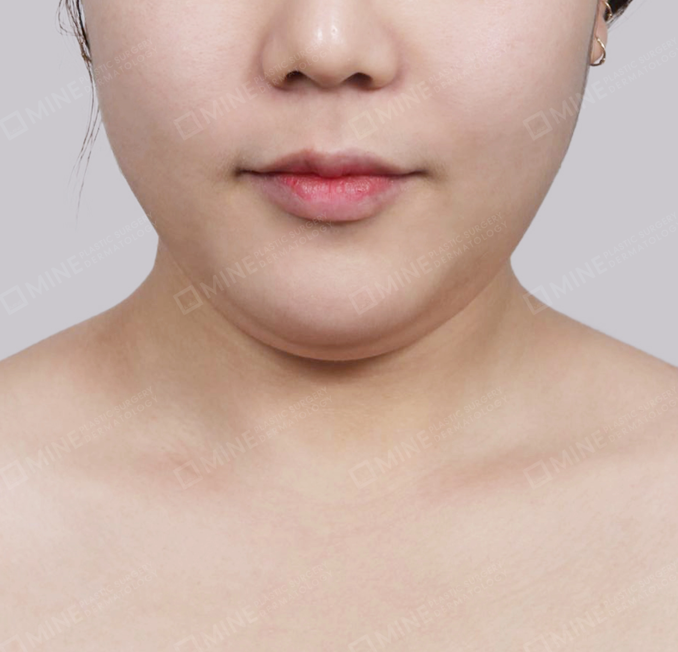 Hút mỡ nọng buộc cơ-Mặt trước-Trước