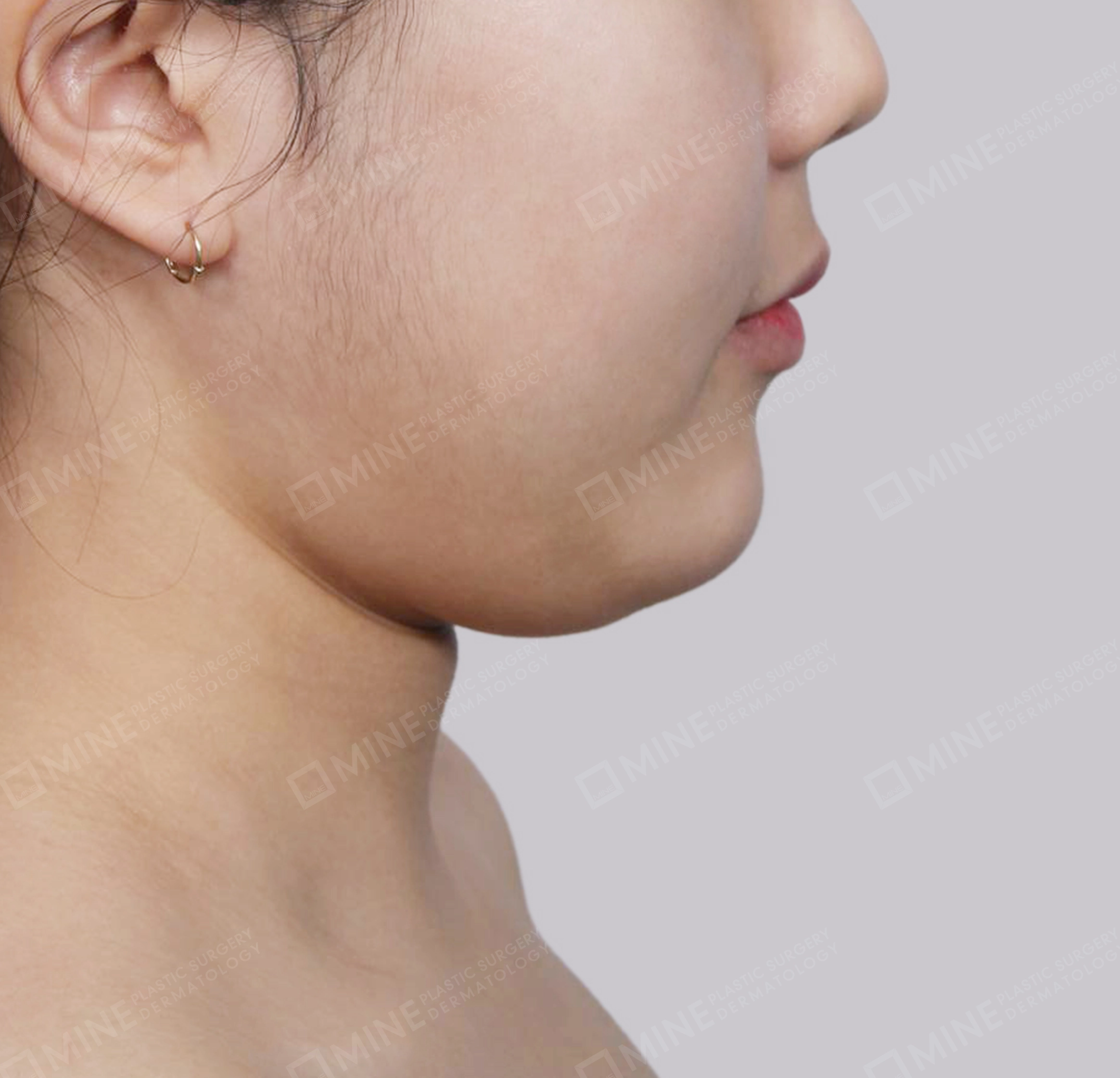 Hút mỡ nọng buộc cơ-Mặt bên-Trước