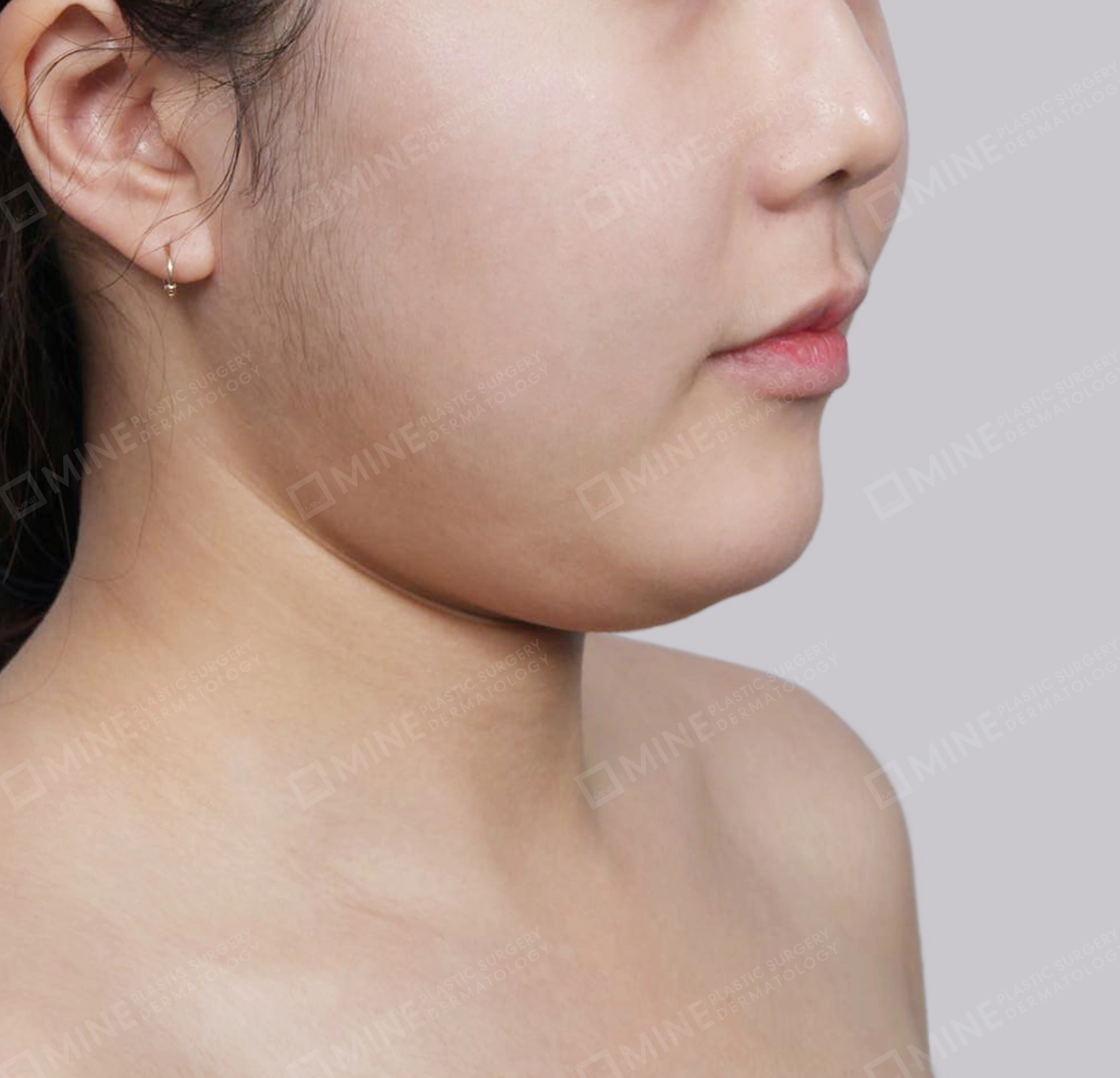 Hút mỡ nọng buộc cơ-45 độ-Trước