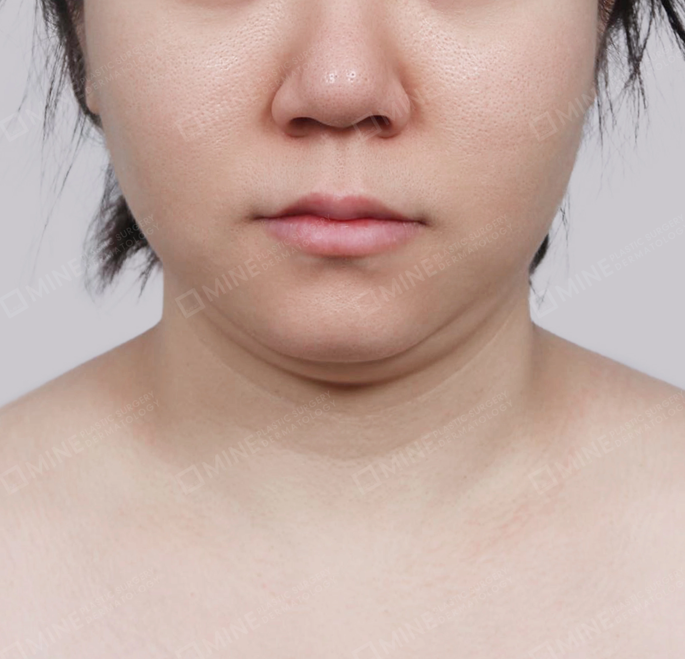 Hút mỡ nọng buộc cơ-Mặt trước-Trước