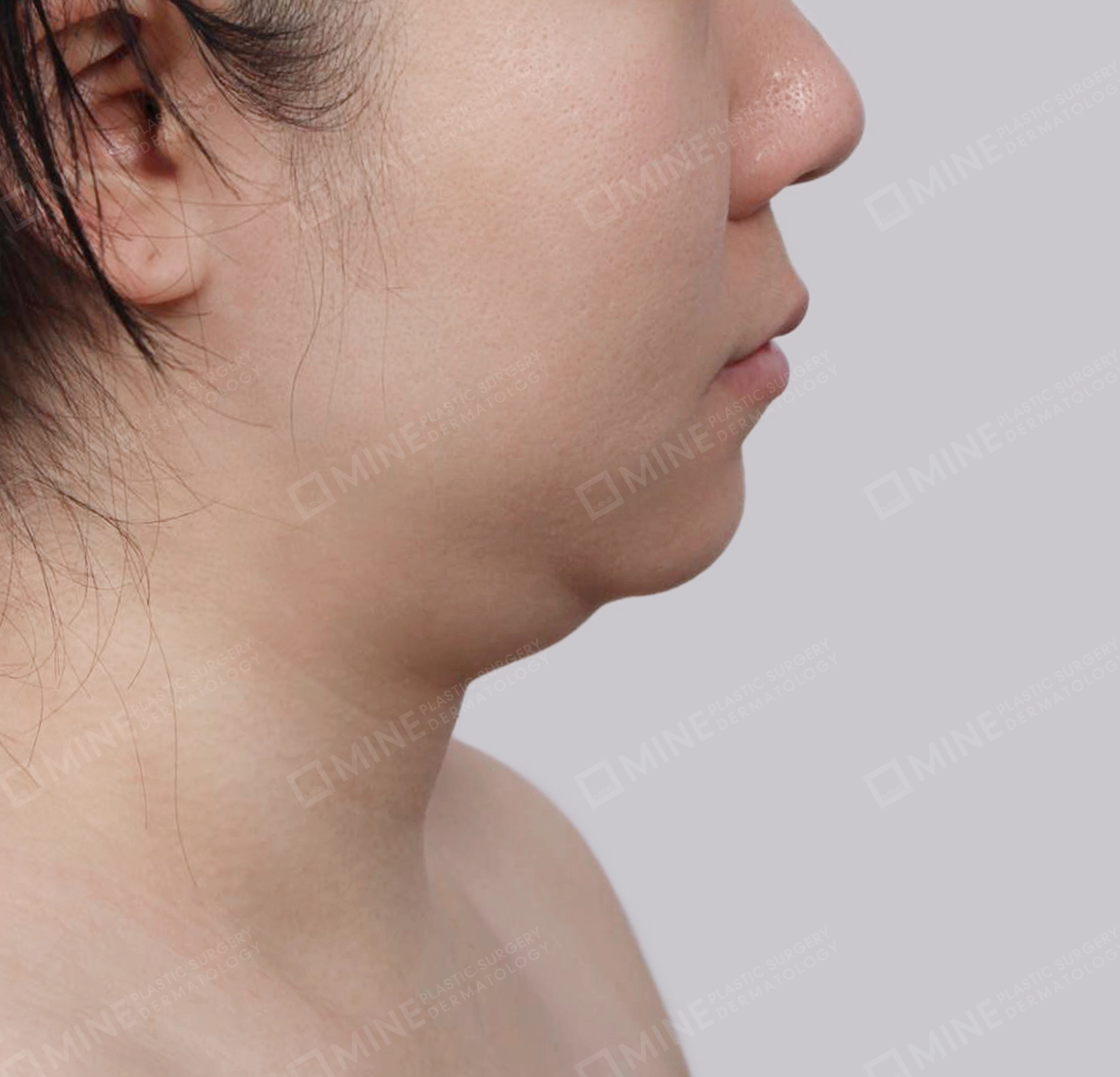 Hút mỡ nọng buộc cơ-Mặt bên-Trước