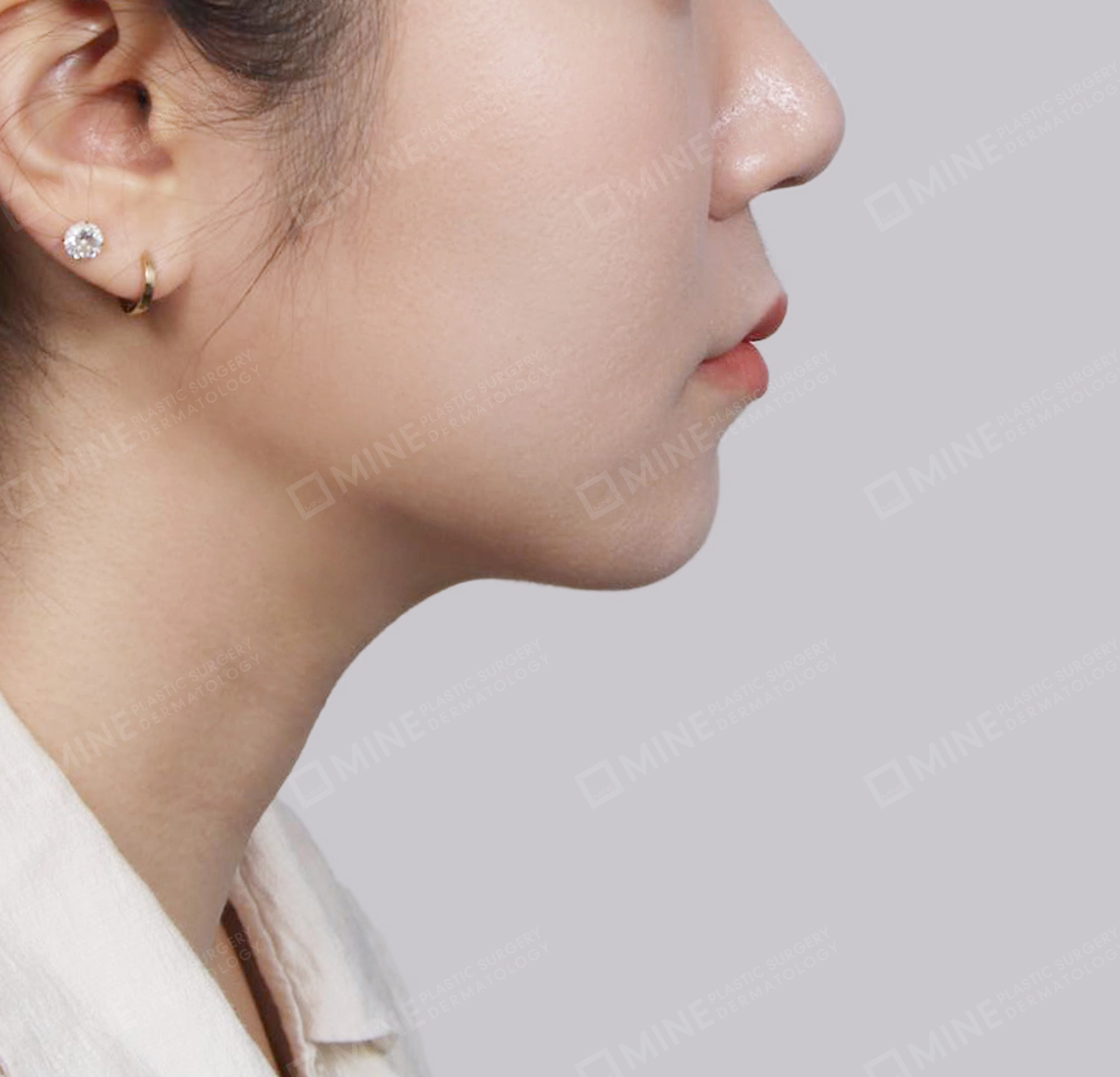 Hút mỡ nọng buộc cơ-Mặt bên-Sau