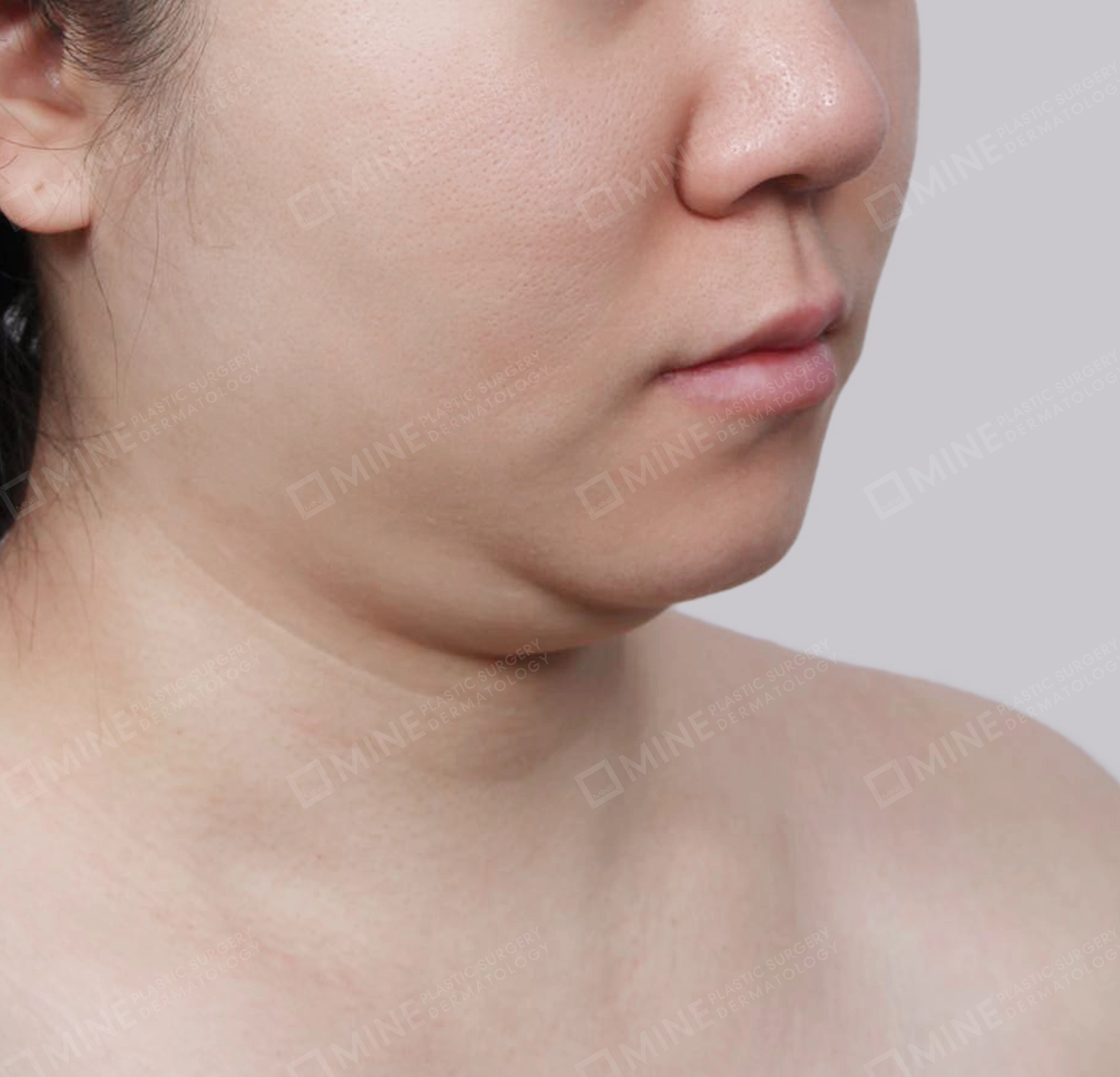 Hút mỡ nọng buộc cơ-45 độ-Trước