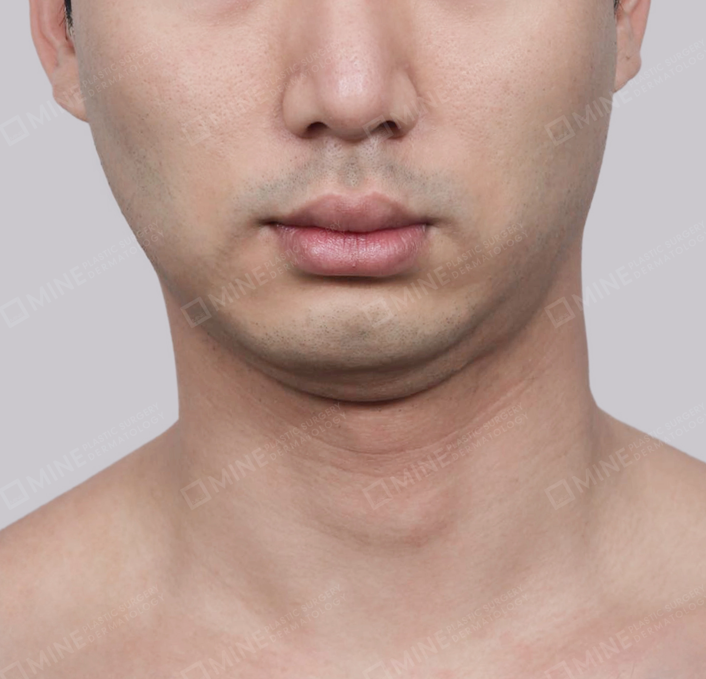 Hút mỡ nọng buộc cơ-Mặt trước-Trước