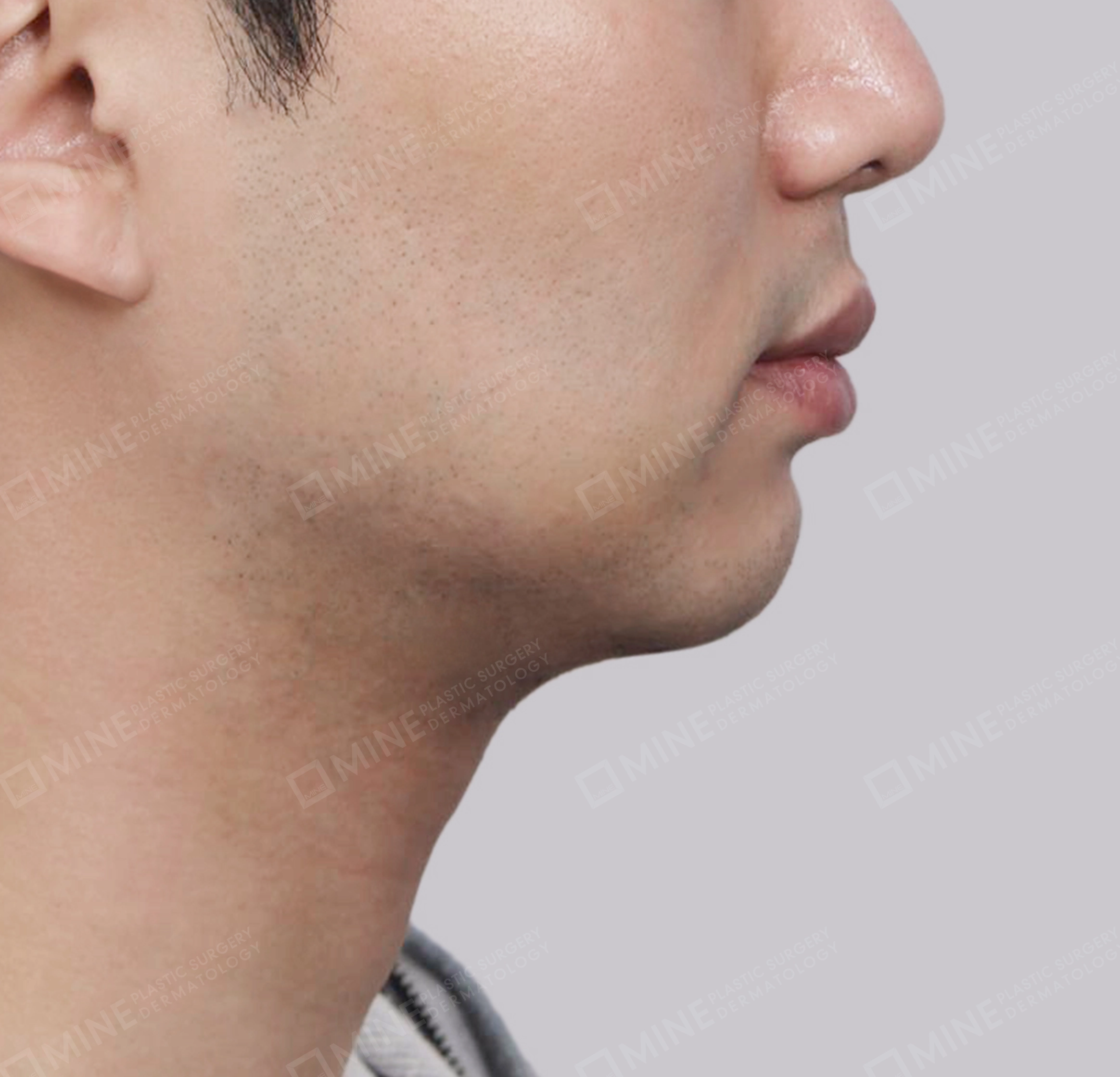 Hút mỡ nọng buộc cơ-Mặt bên-Sau