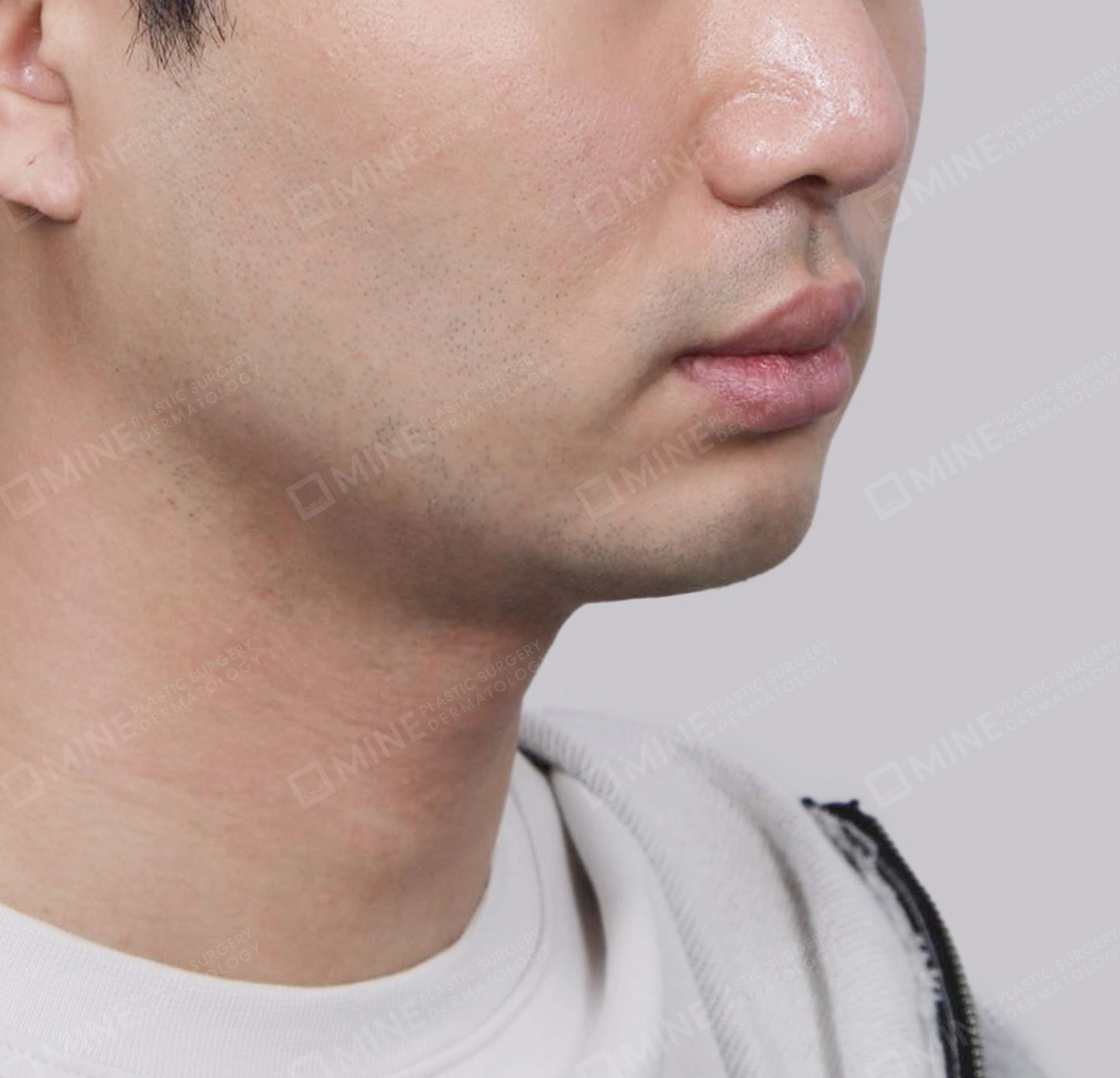 Hút mỡ nọng buộc cơ-45 độ-Sau