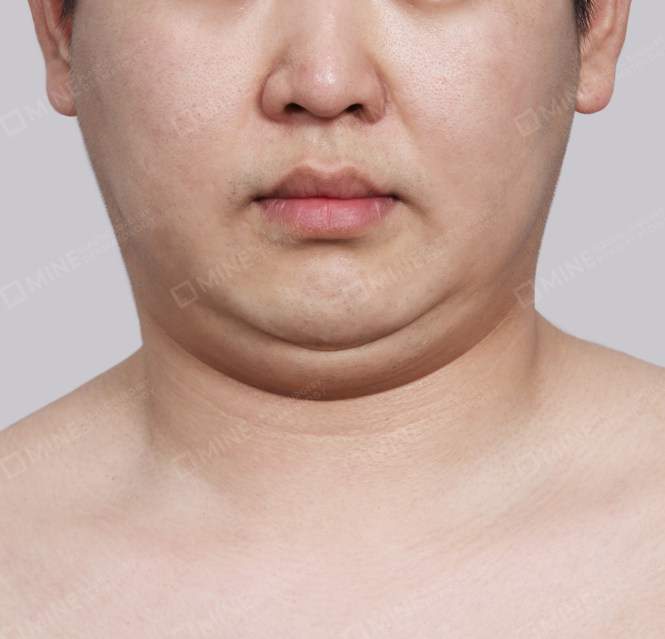 Hút mỡ nọng buộc cơ-Mặt trước-Trước