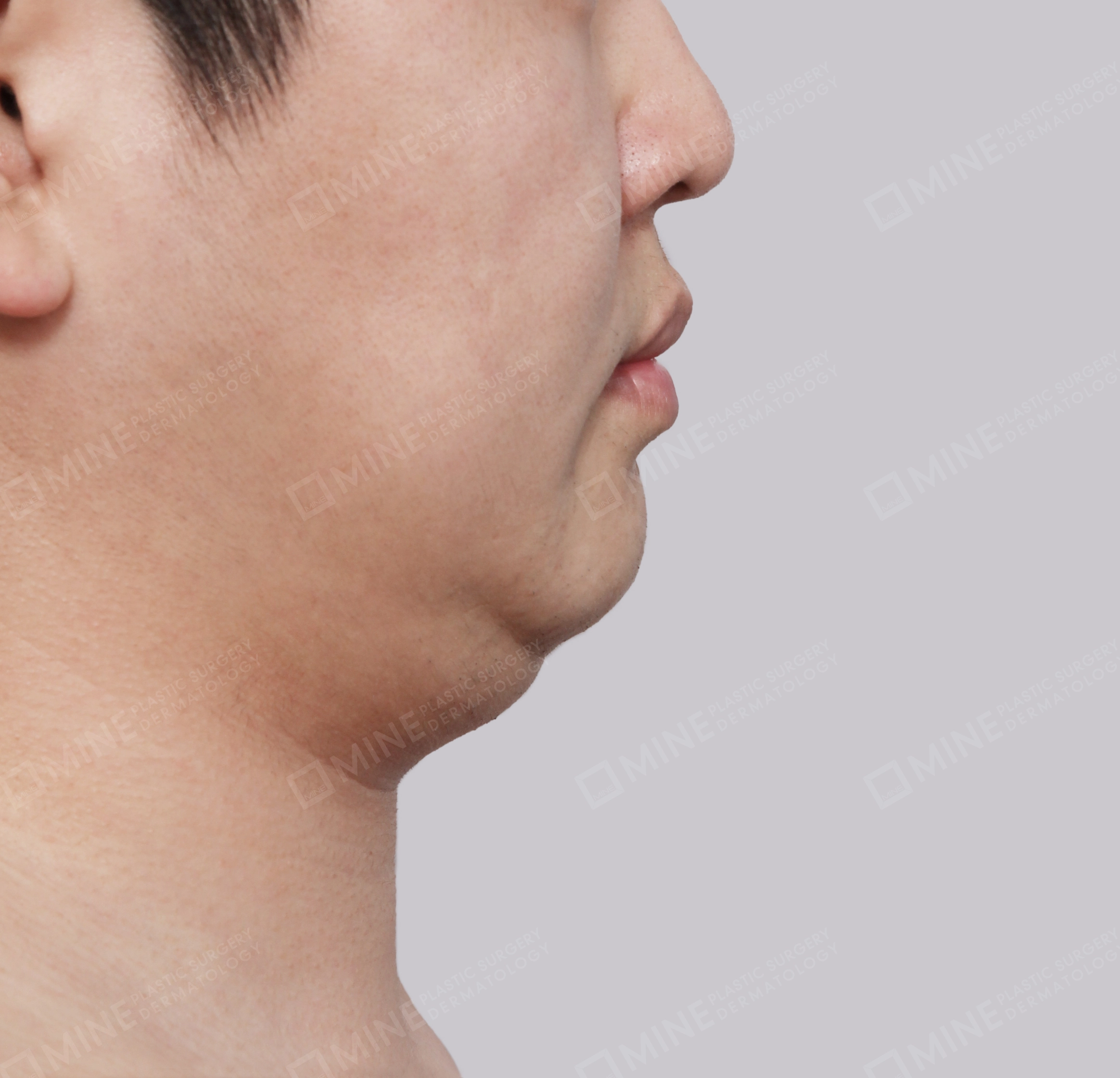 Hút mỡ nọng buộc cơ-Mặt bên-Trước