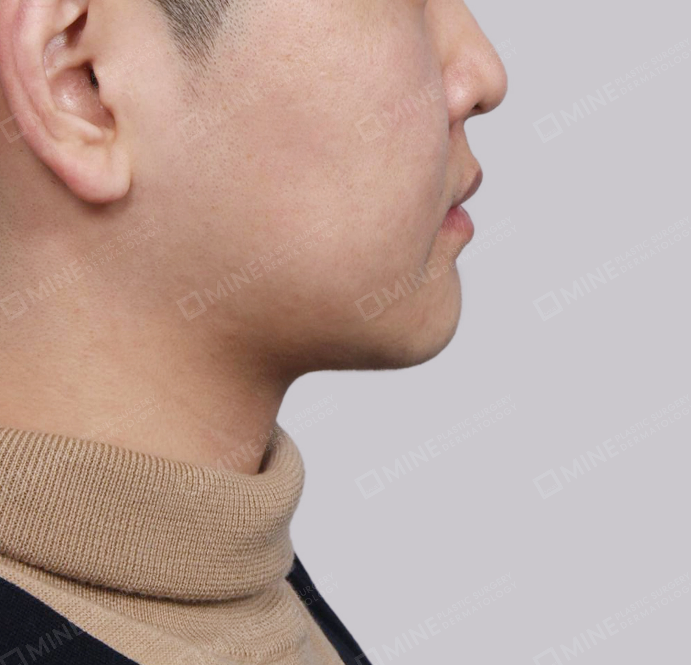Hút mỡ nọng buộc cơ-Mặt bên-Sau
