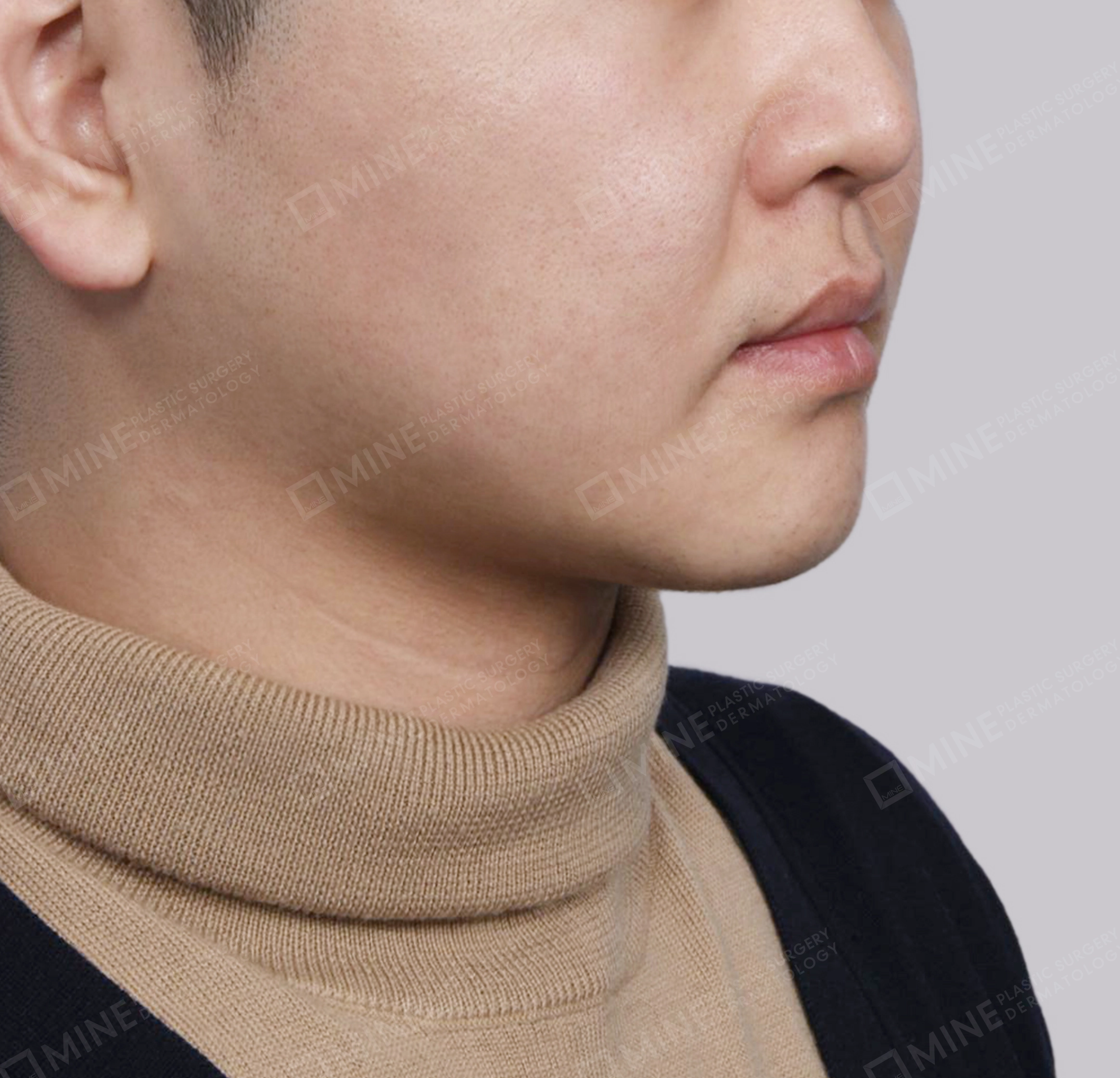 Hút mỡ nọng buộc cơ-45 độ-Sau