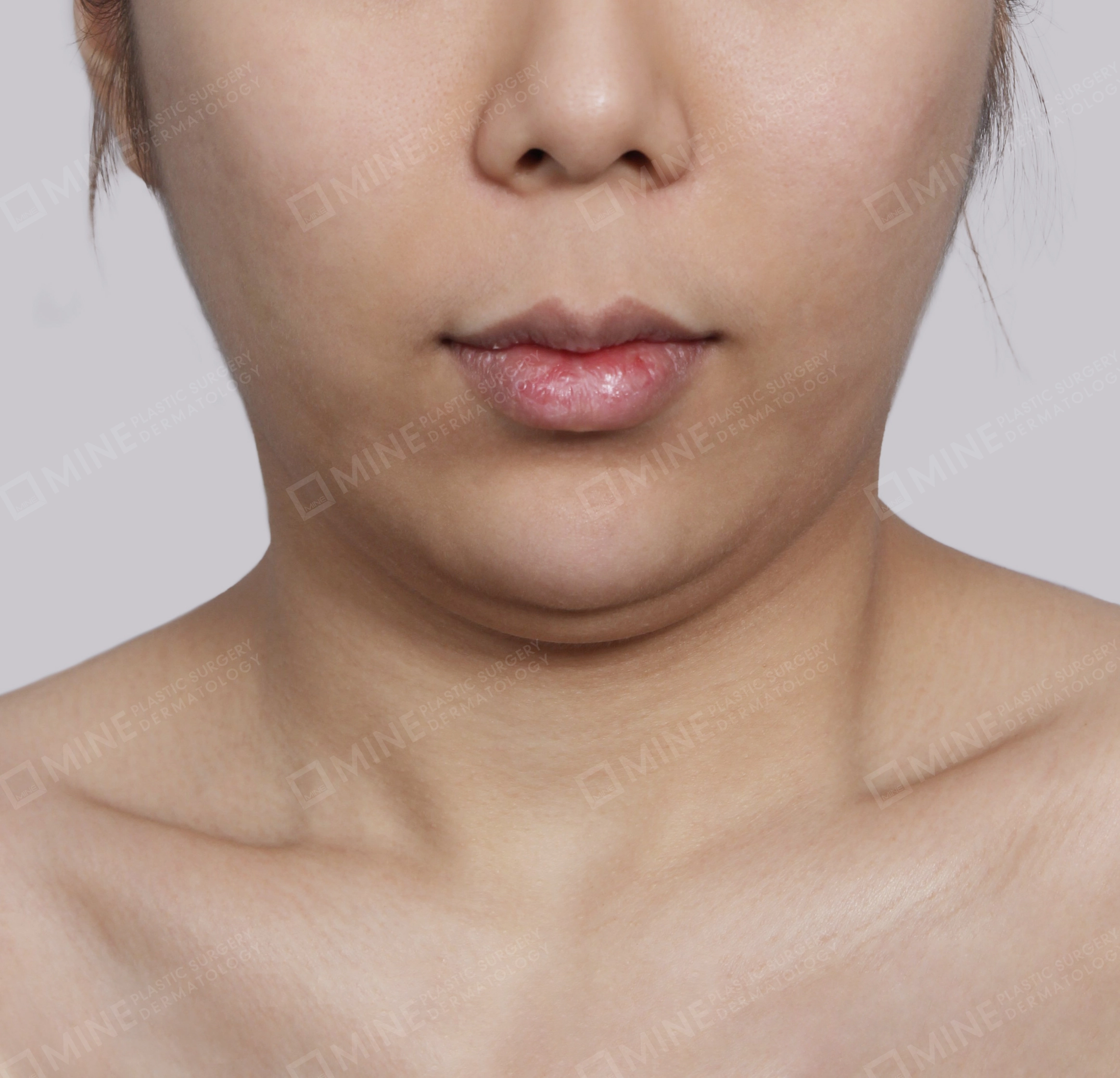 Hút mỡ nọng buộc cơ-Mặt trước-Trước