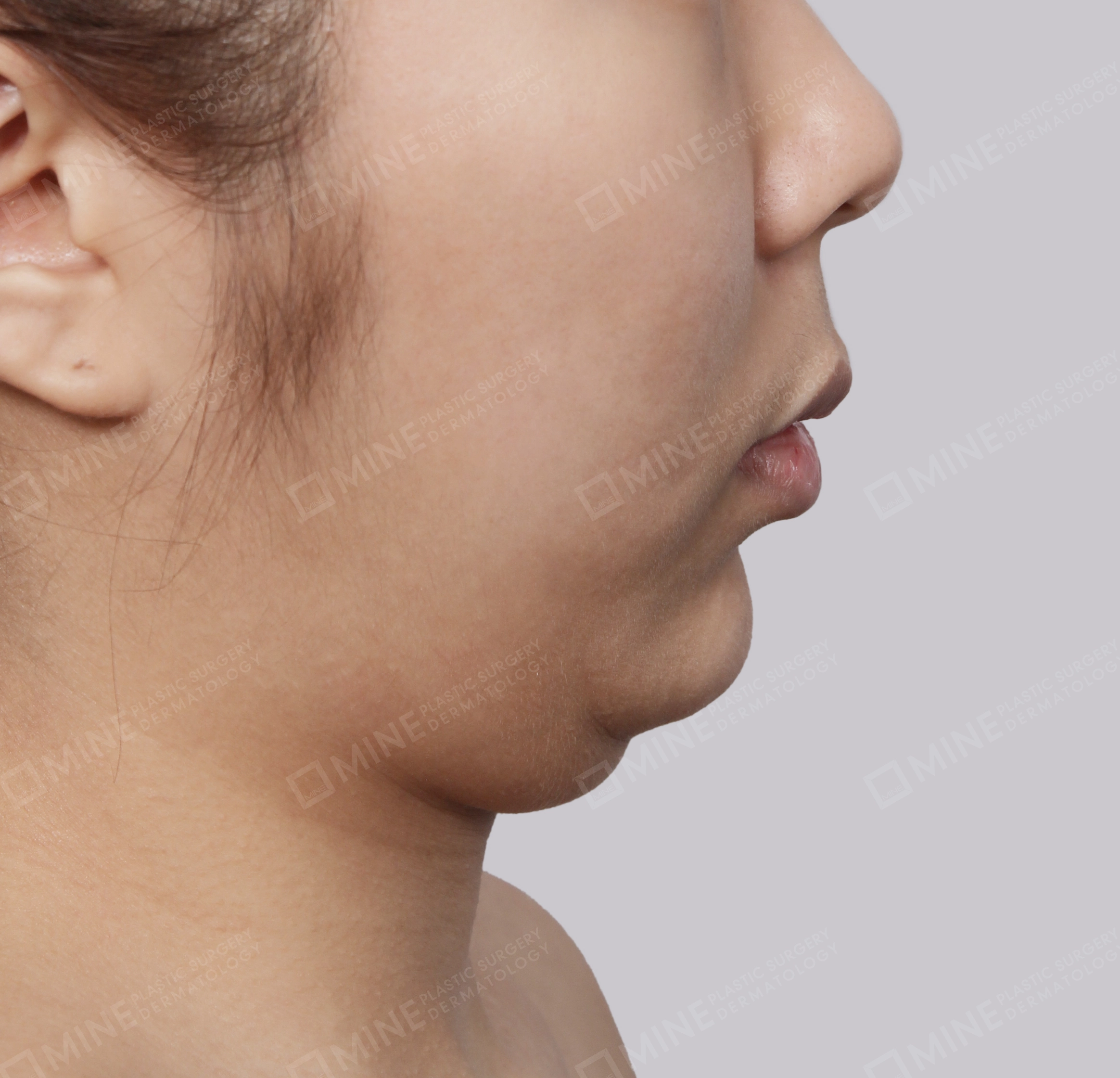 Hút mỡ nọng buộc cơ-Mặt bên-Trước