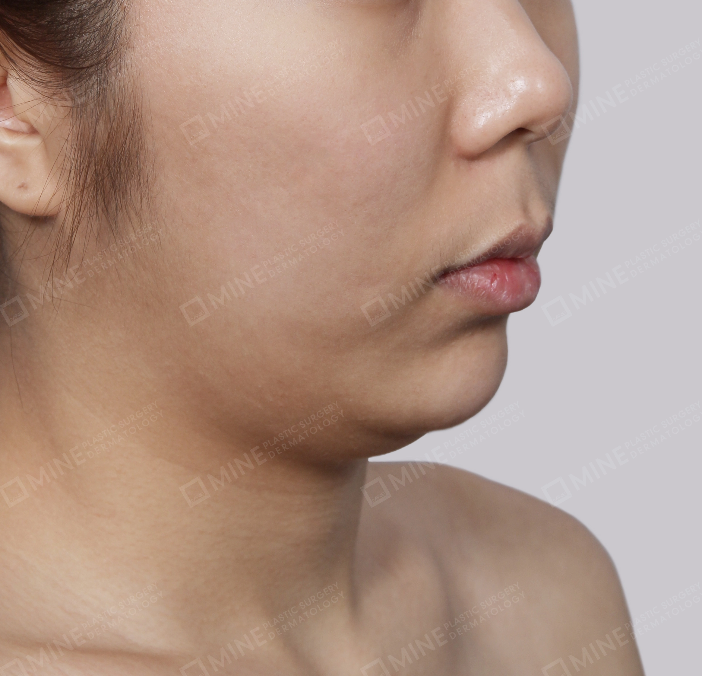 Hút mỡ nọng buộc cơ-45 độ-Trước