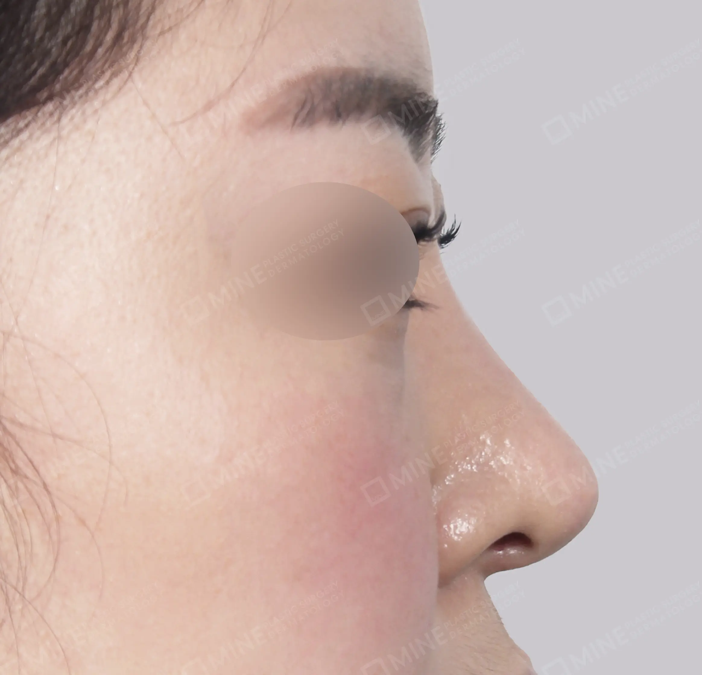 Tái phẫu thuật mũi-측면-후