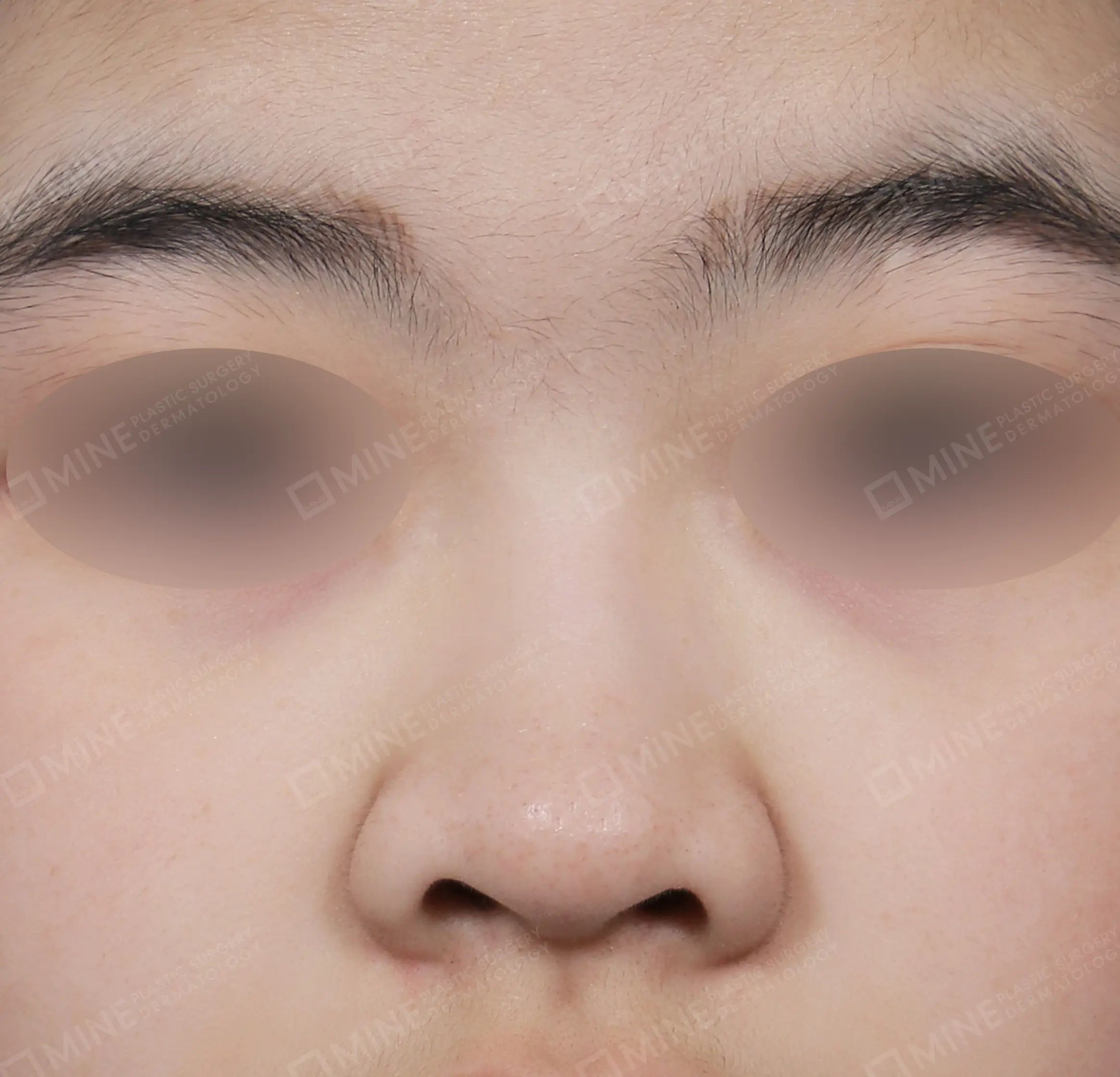 Nâng sống mũi + kéo dài đầu mũi + thu gọn đầu mũi + cắt cánh mũi-정면-전