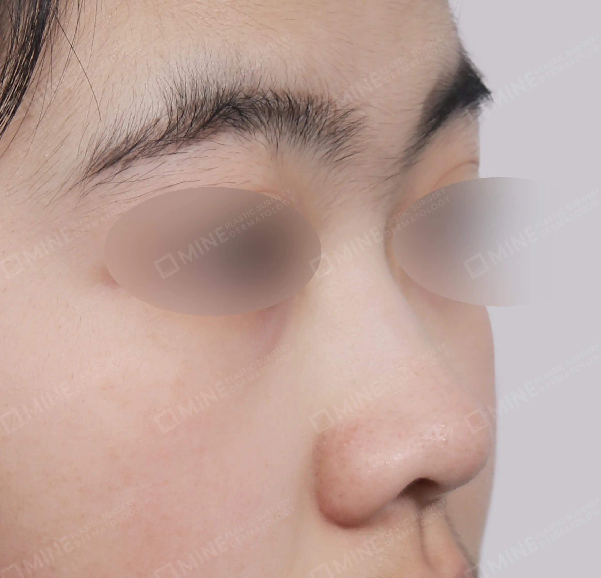 Nâng sống mũi + kéo dài đầu mũi + thu gọn đầu mũi + cắt cánh mũi-45도-전