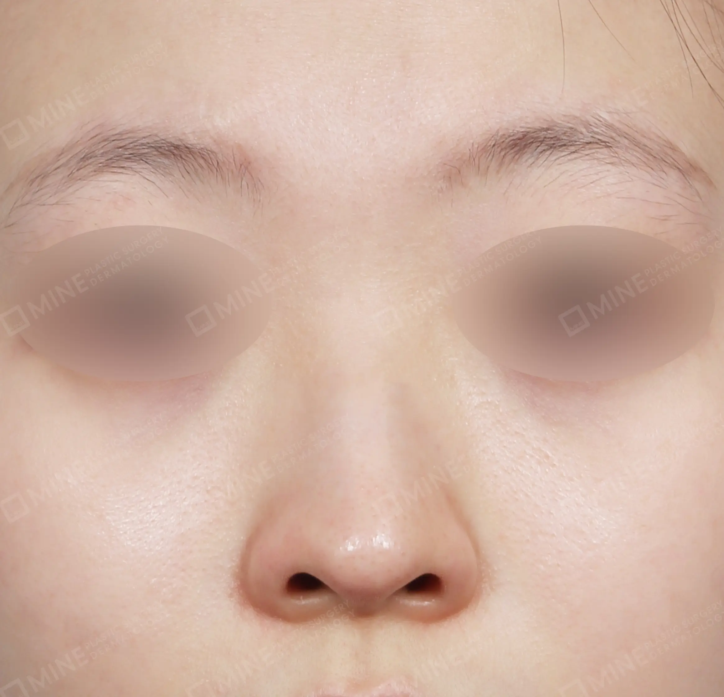 Nâng sống mũi + đầu mũi + mài gồ + chỉnh hình mũi lệch-정면-전