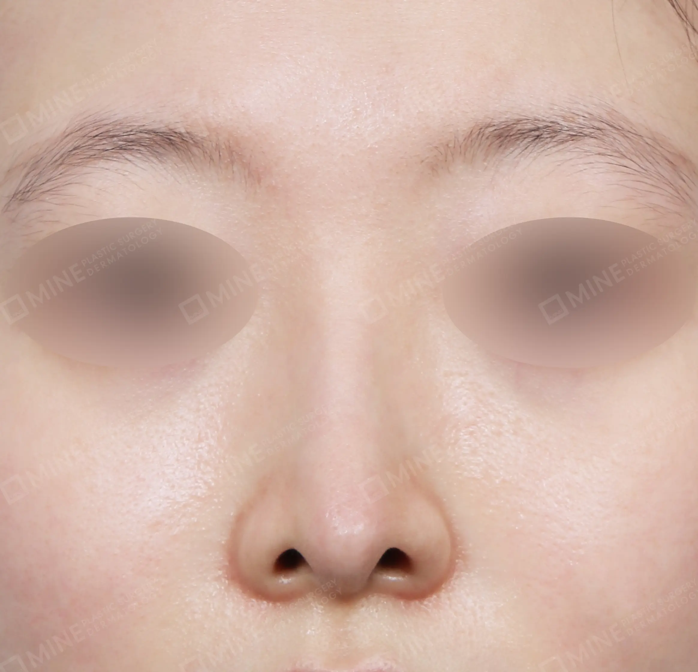 Nâng sống mũi + đầu mũi + mài gồ + chỉnh hình mũi lệch-정면-후