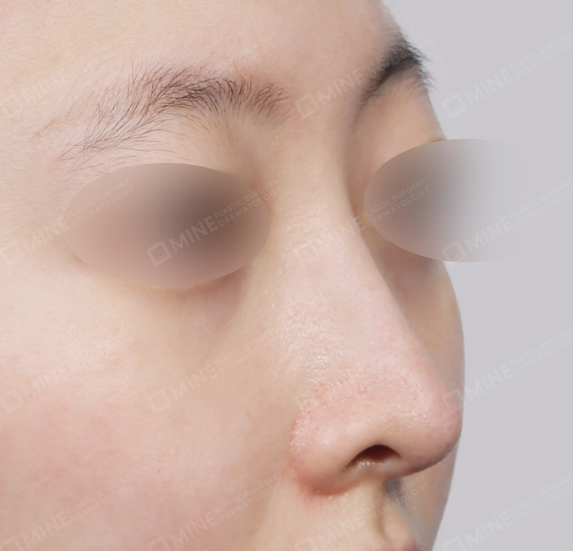 Nâng sống mũi + đầu mũi + mài gồ + chỉnh hình mũi lệch-45도-후